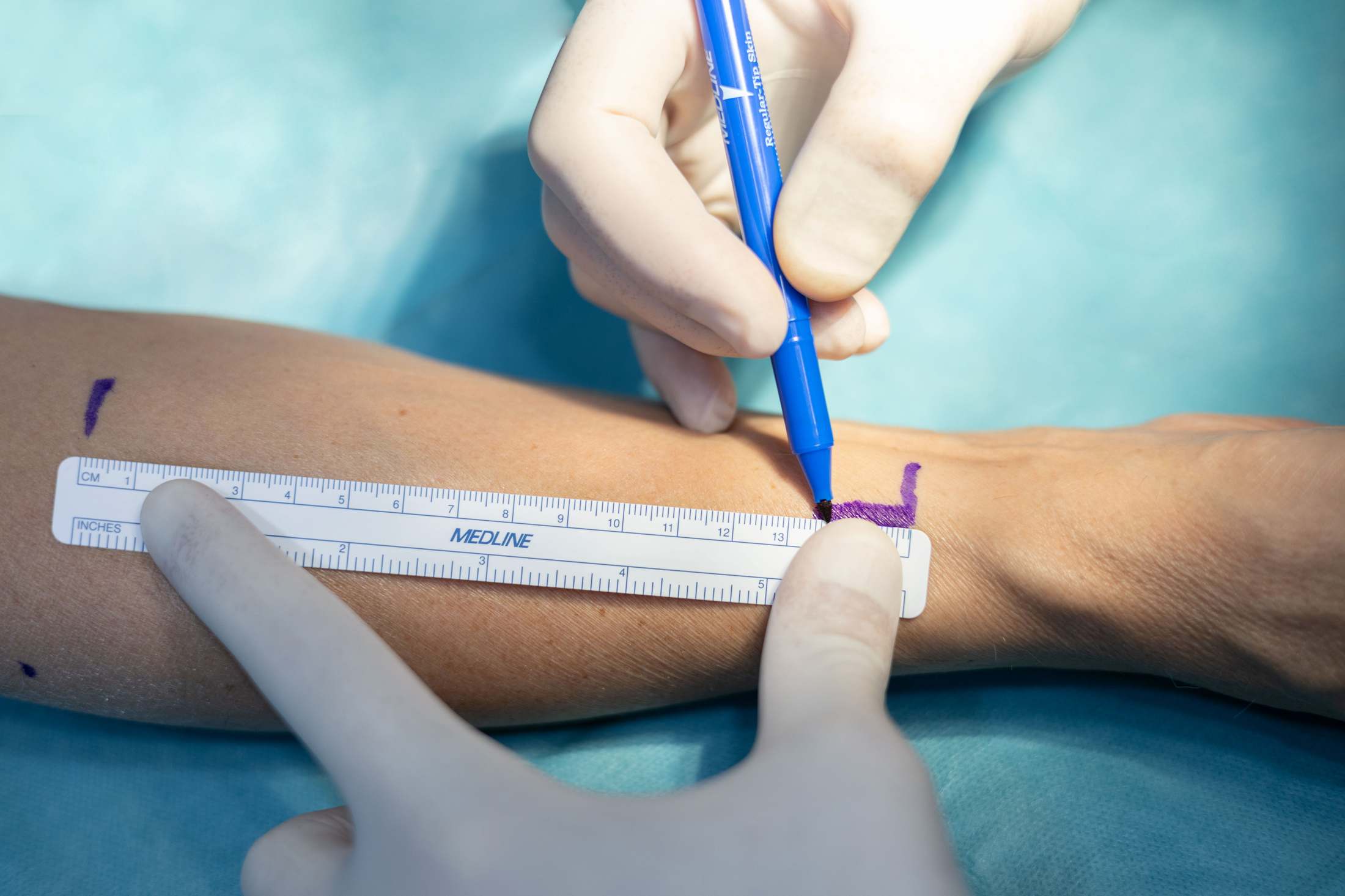 Planificación quirúrgica: marcaje y medición