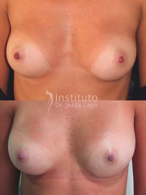 Aumento de pecho feminizante: antes y después