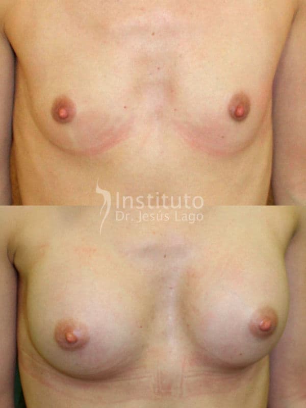 Aumento de pecho feminizante: antes y después