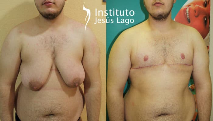 Top surgery: before and after