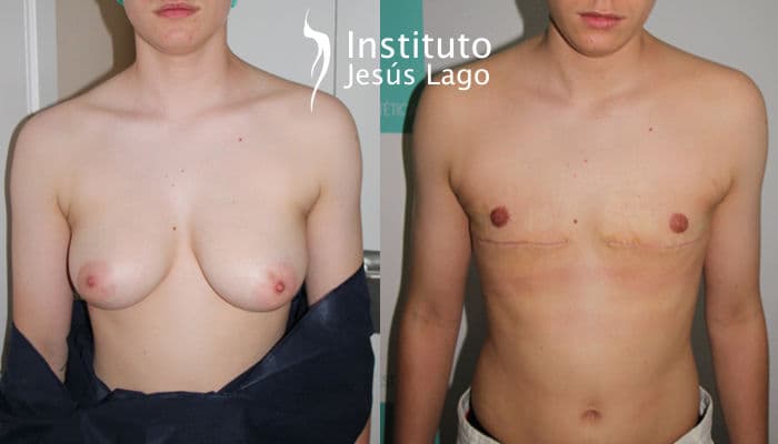 Top surgery: before and after