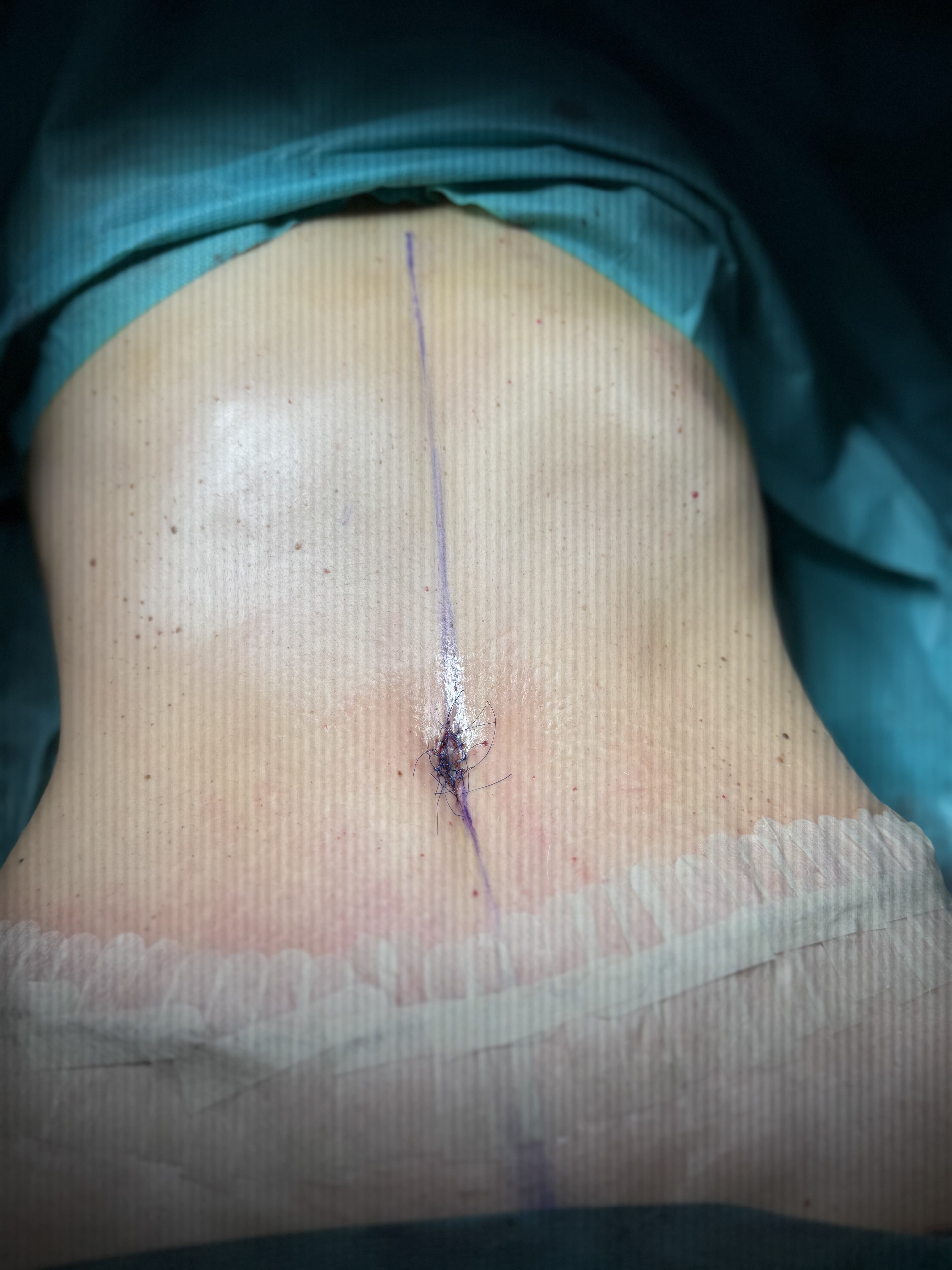 Tummy tuck: after
