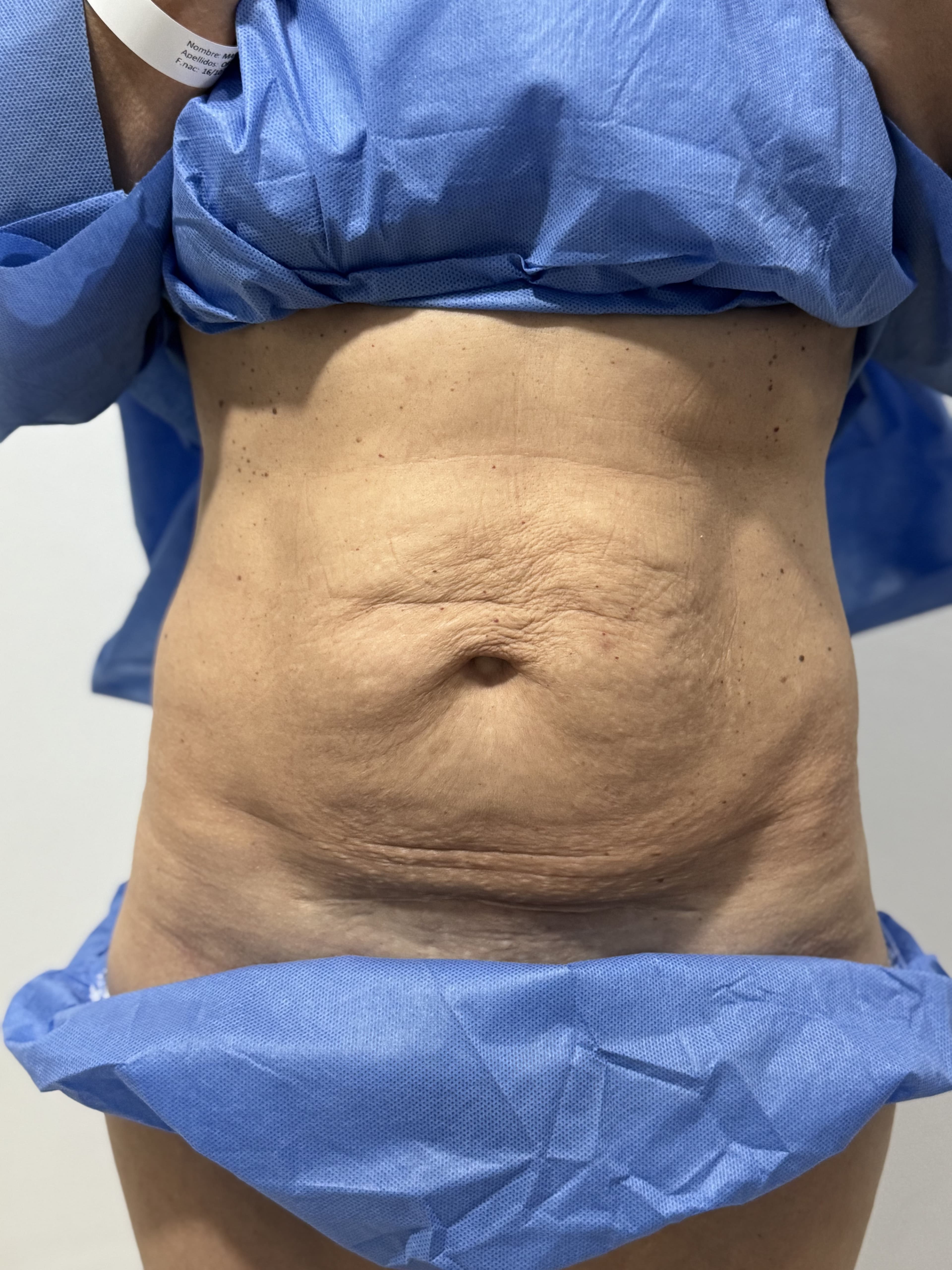 Tummy tuck: before