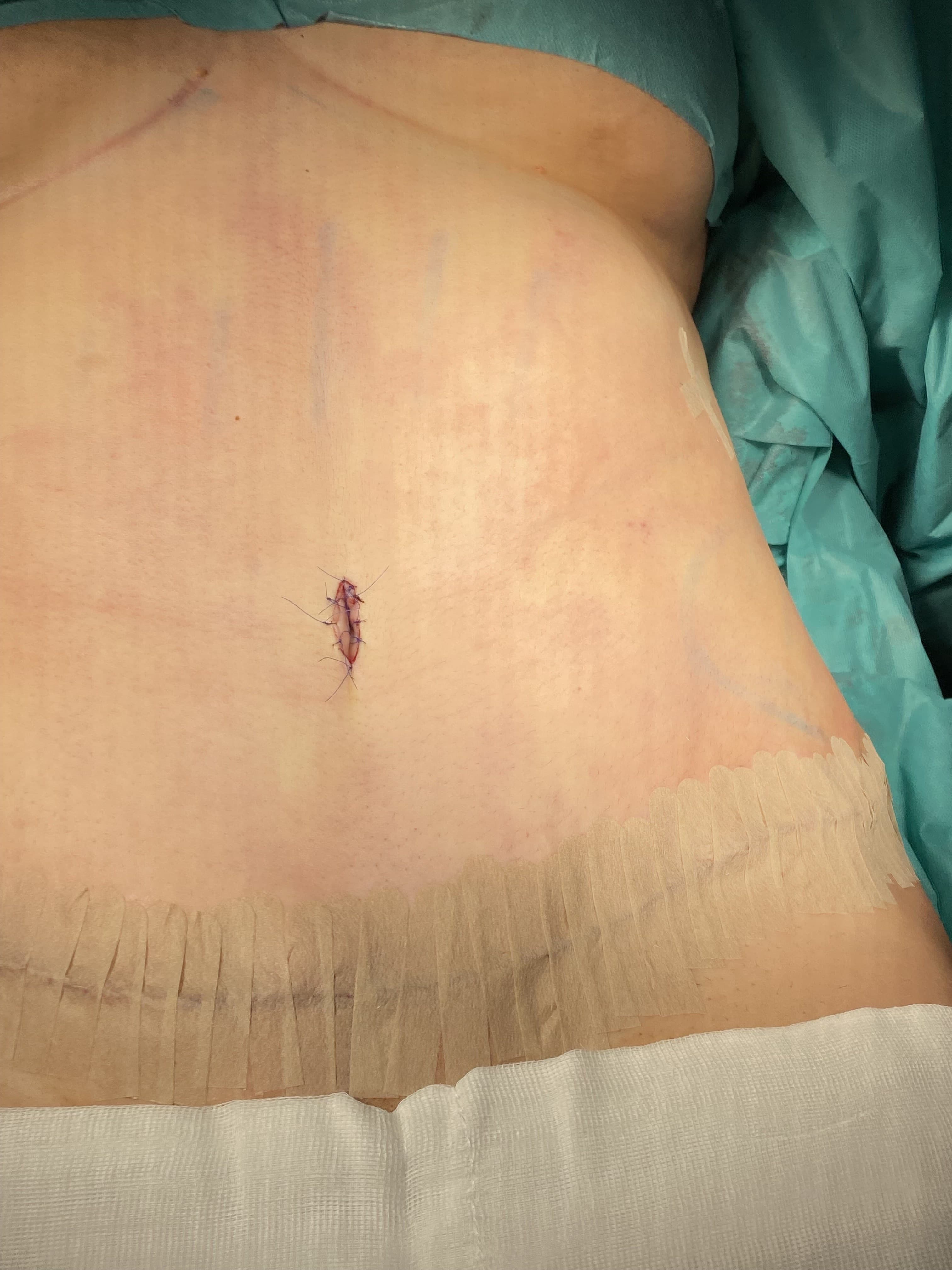 Tummy tuck: after