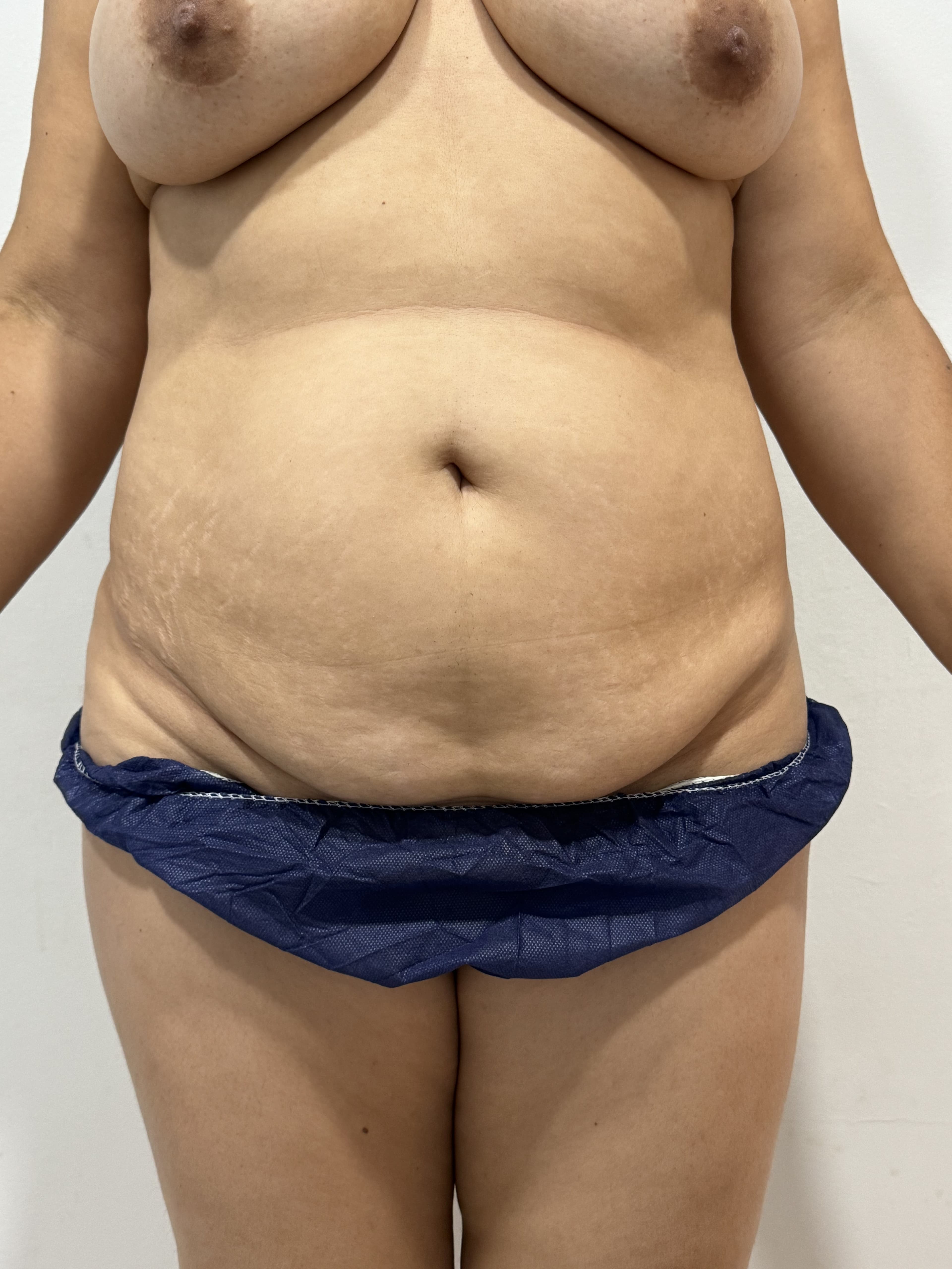 Tummy tuck: before