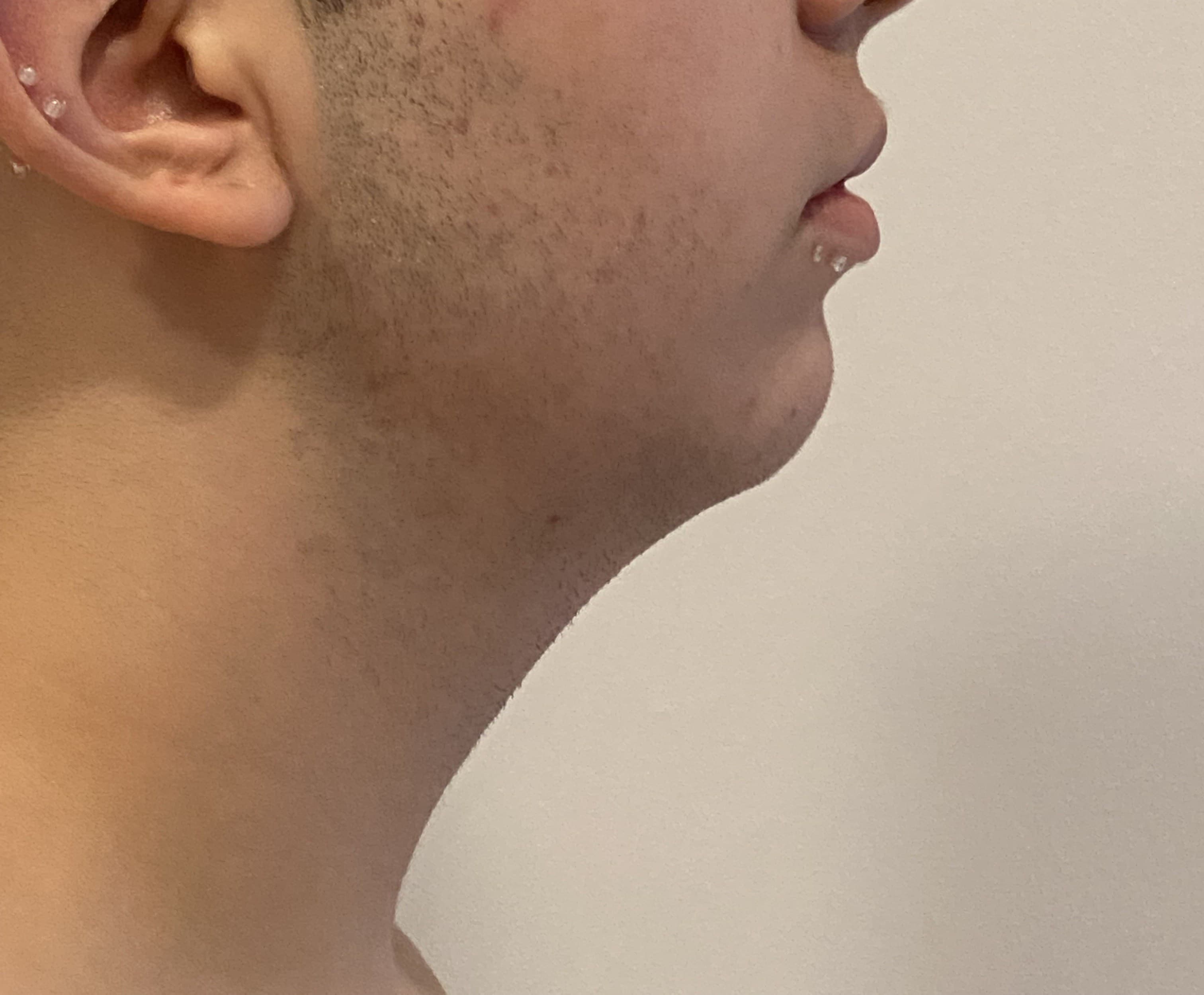 Mentoplastia: antes