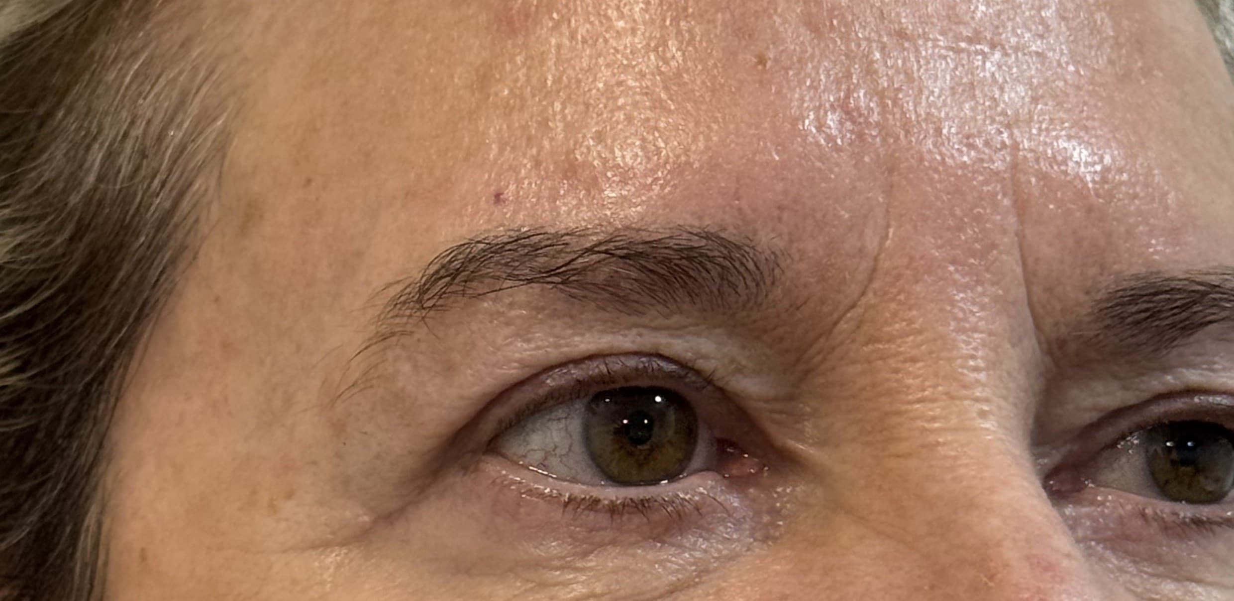 Blefaroplastia: después