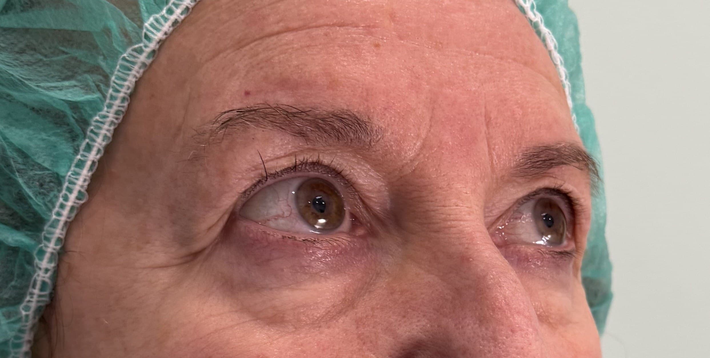 Blefaroplastia: antes