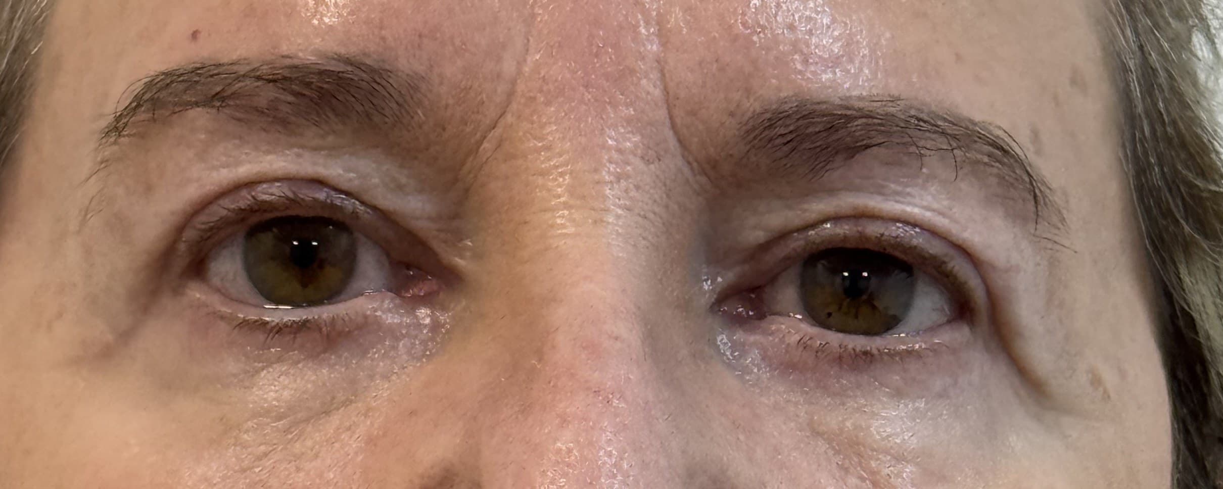 Blefaroplastia: después