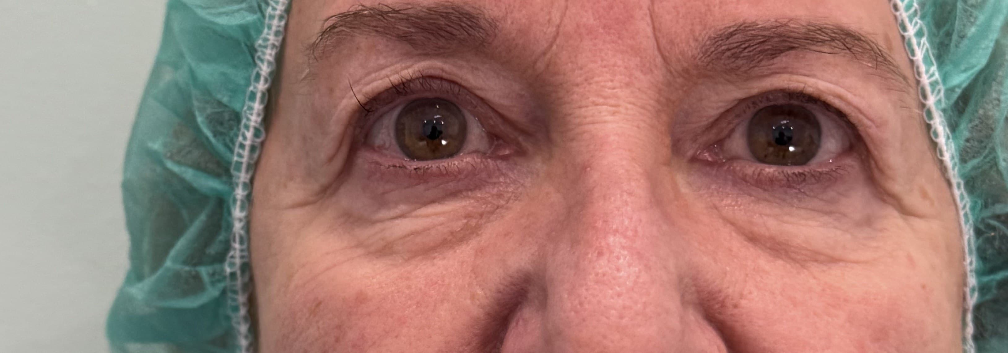 Blefaroplastia: antes