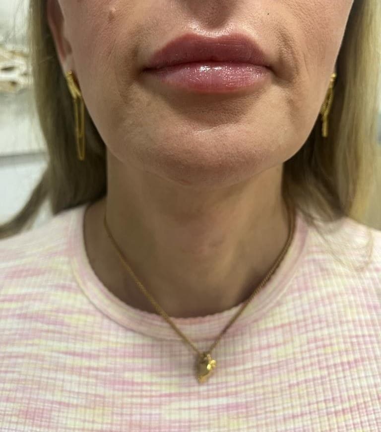 Feminización mandibular: después