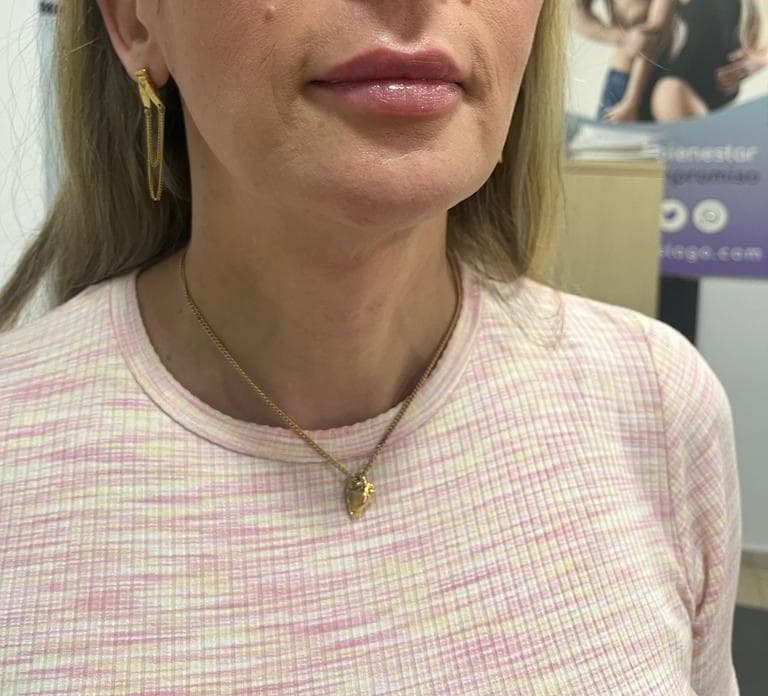 Feminización mandibular: después