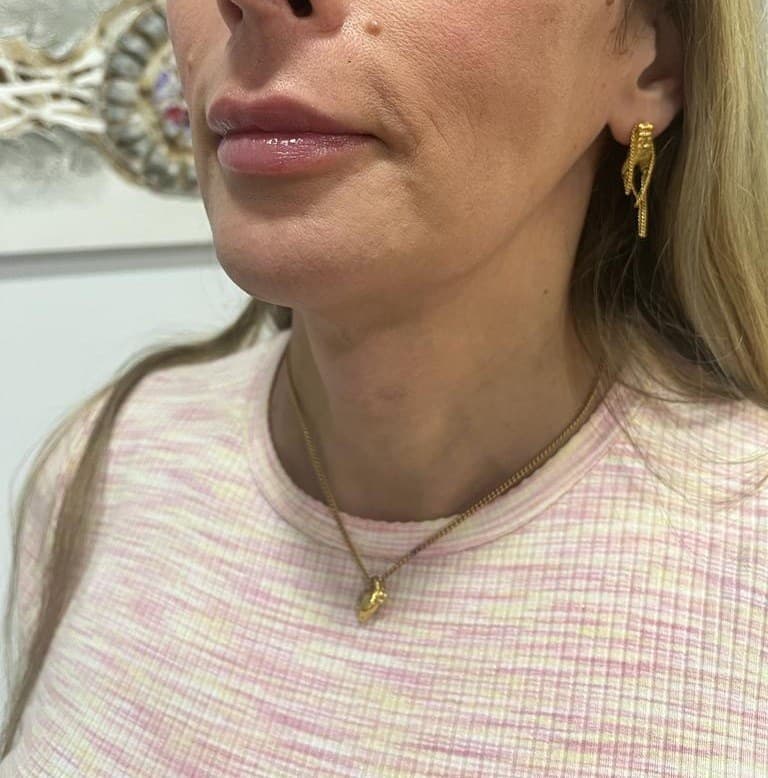 Feminización mandibular: después