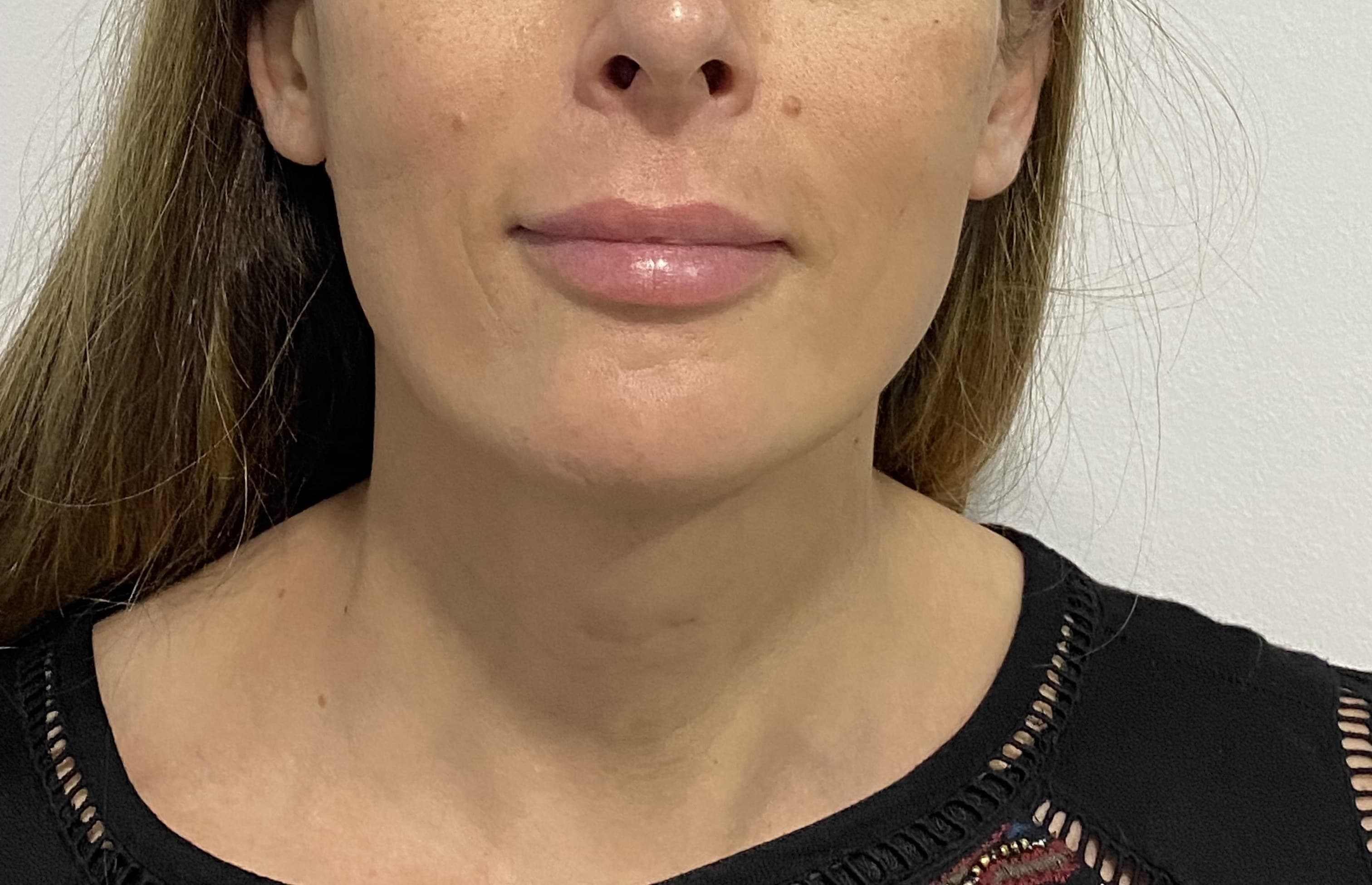 Feminización mandibular: después
