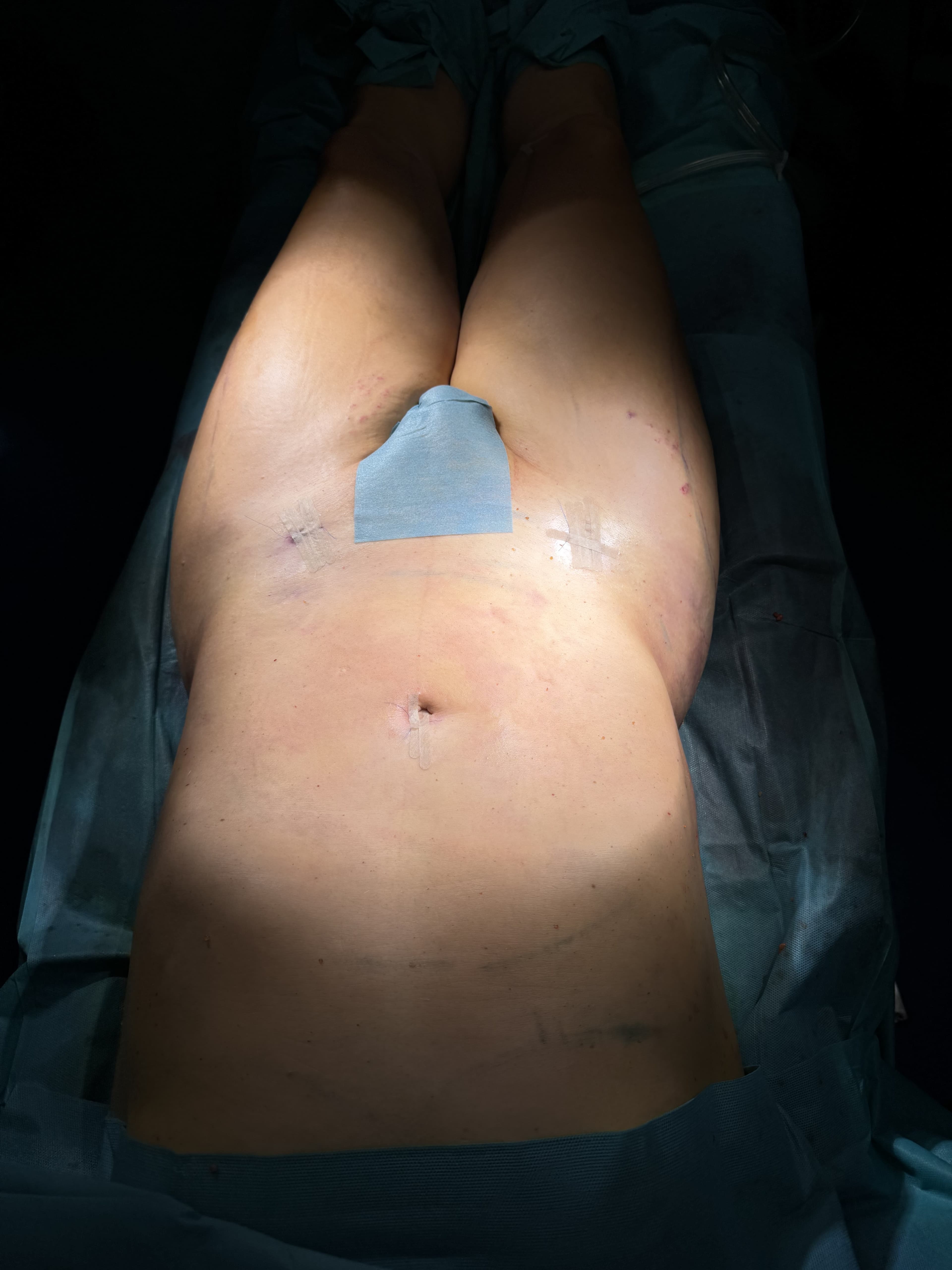 Feminización del contorno corporal: después