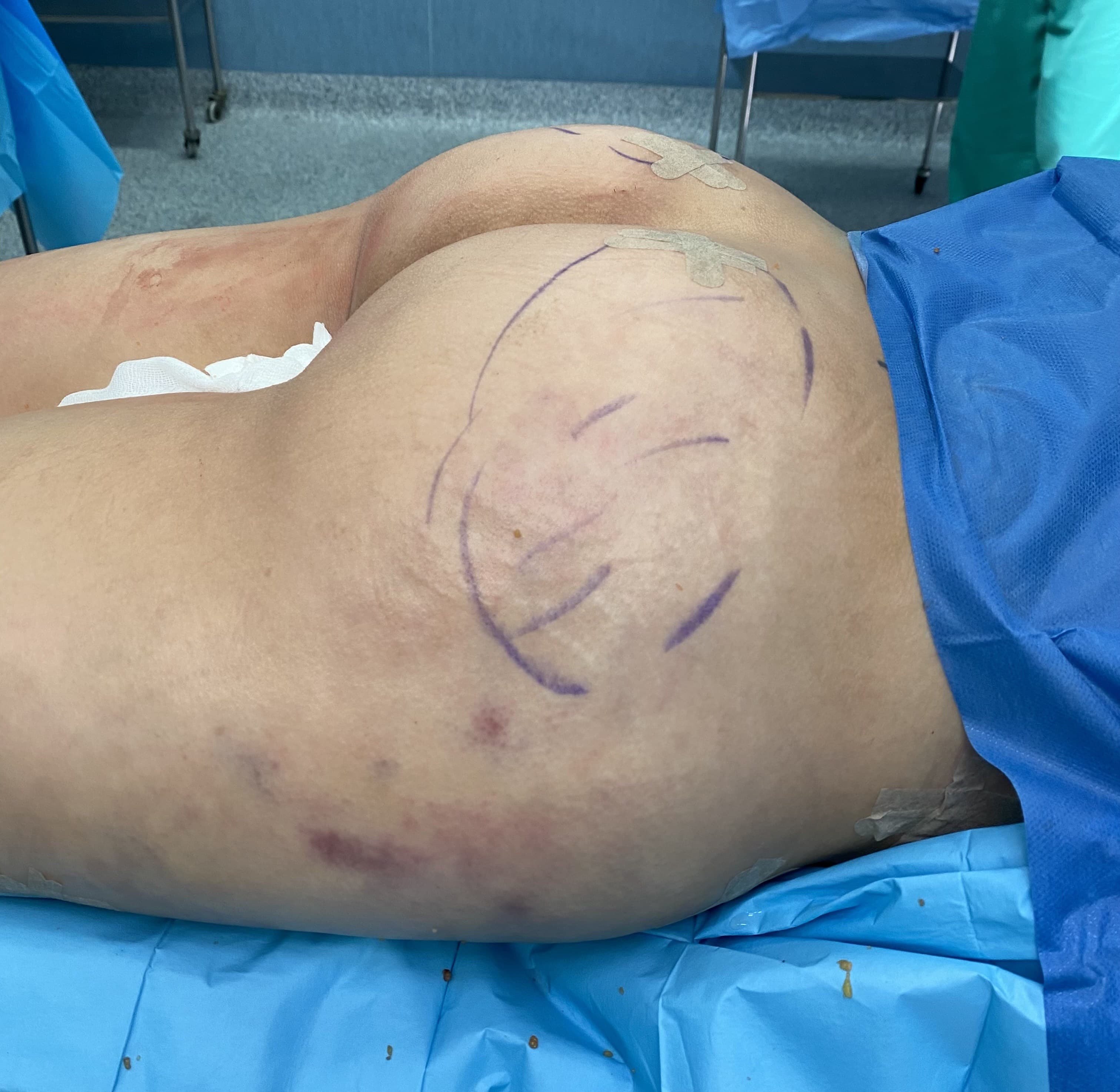 Gluteoplastia: después