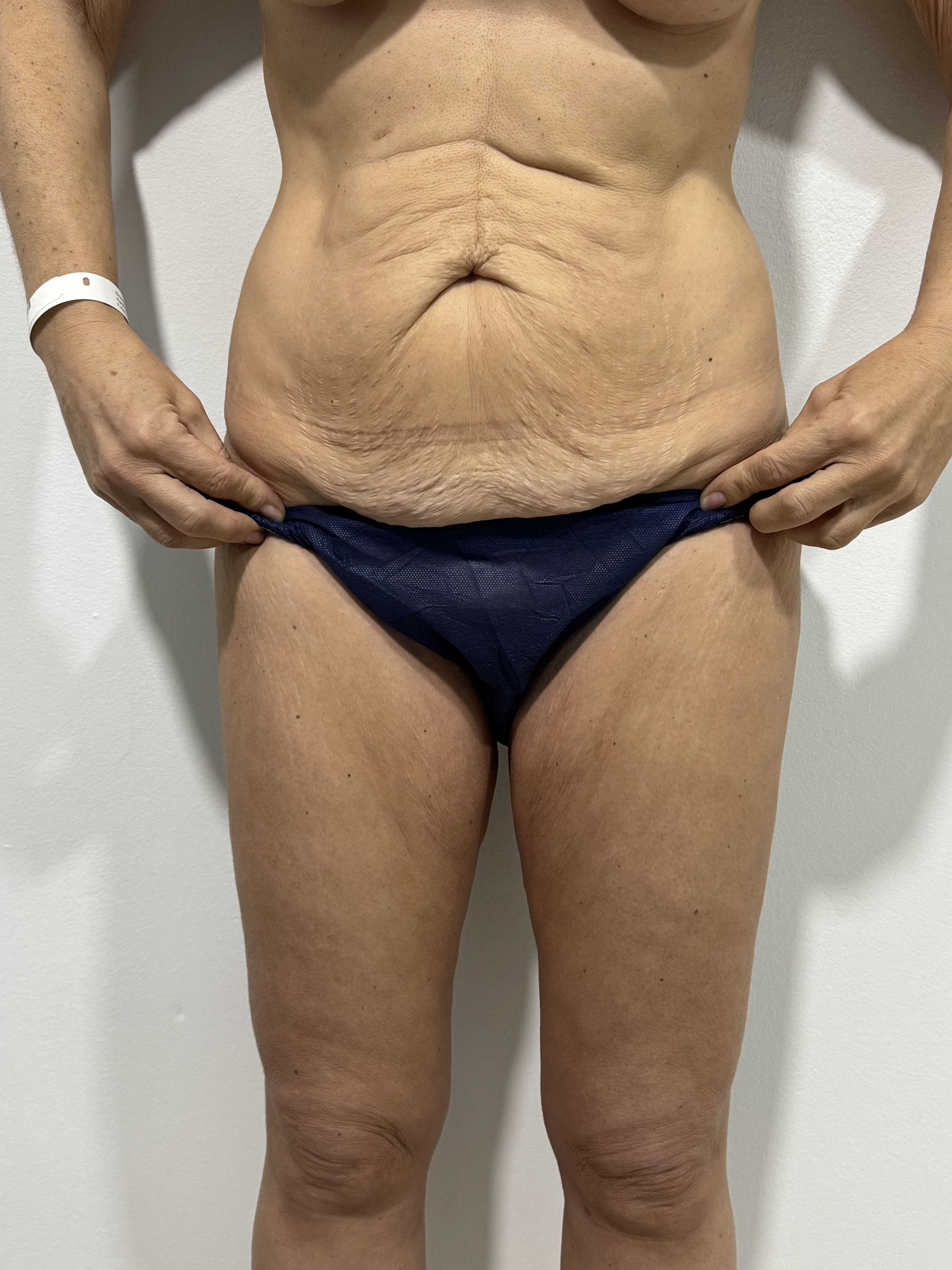 Lifting de muslos: antes