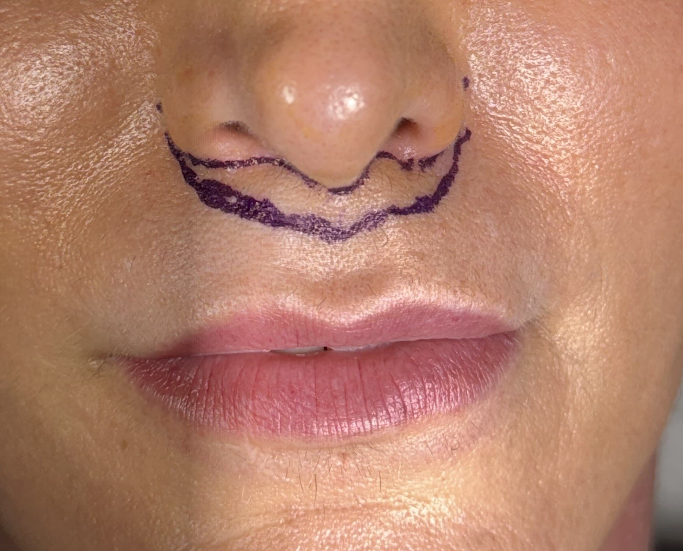 Lifting de labio superior: antes