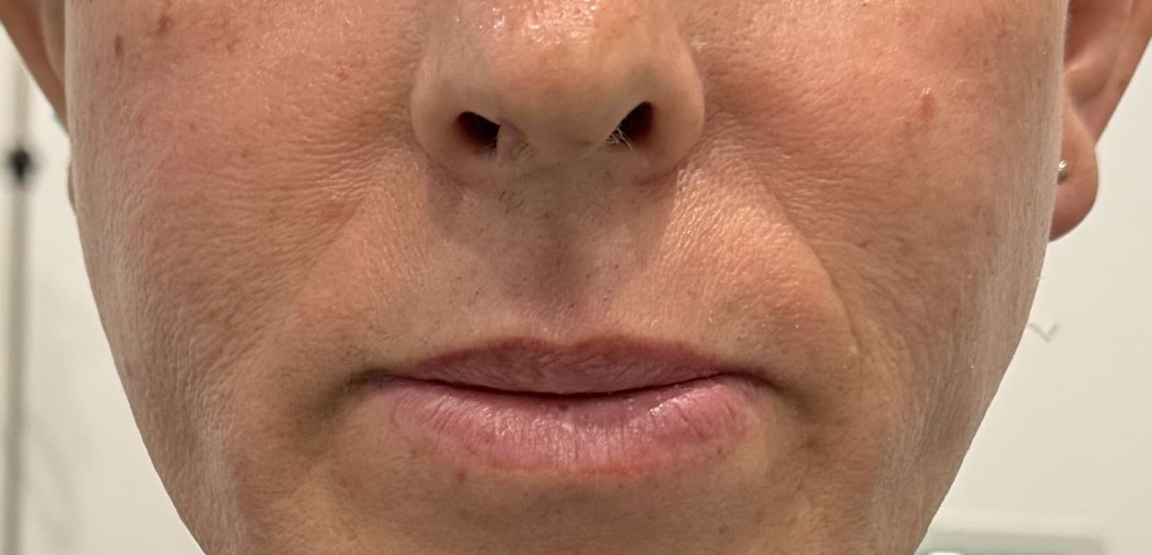 Lifting de labio superior: antes