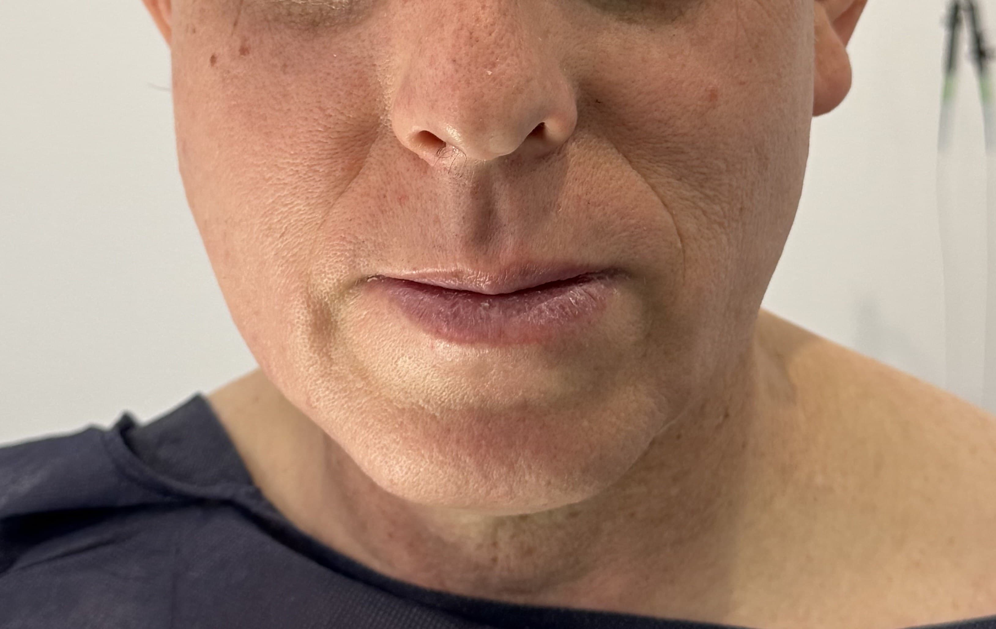 Malarplastia: antes