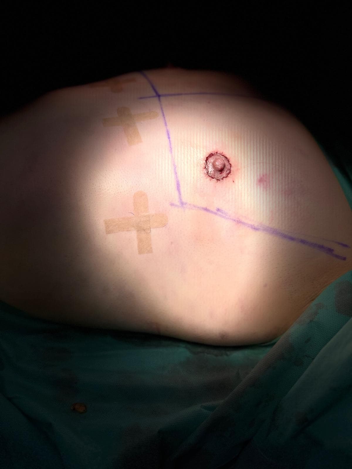 Top surgery: after
