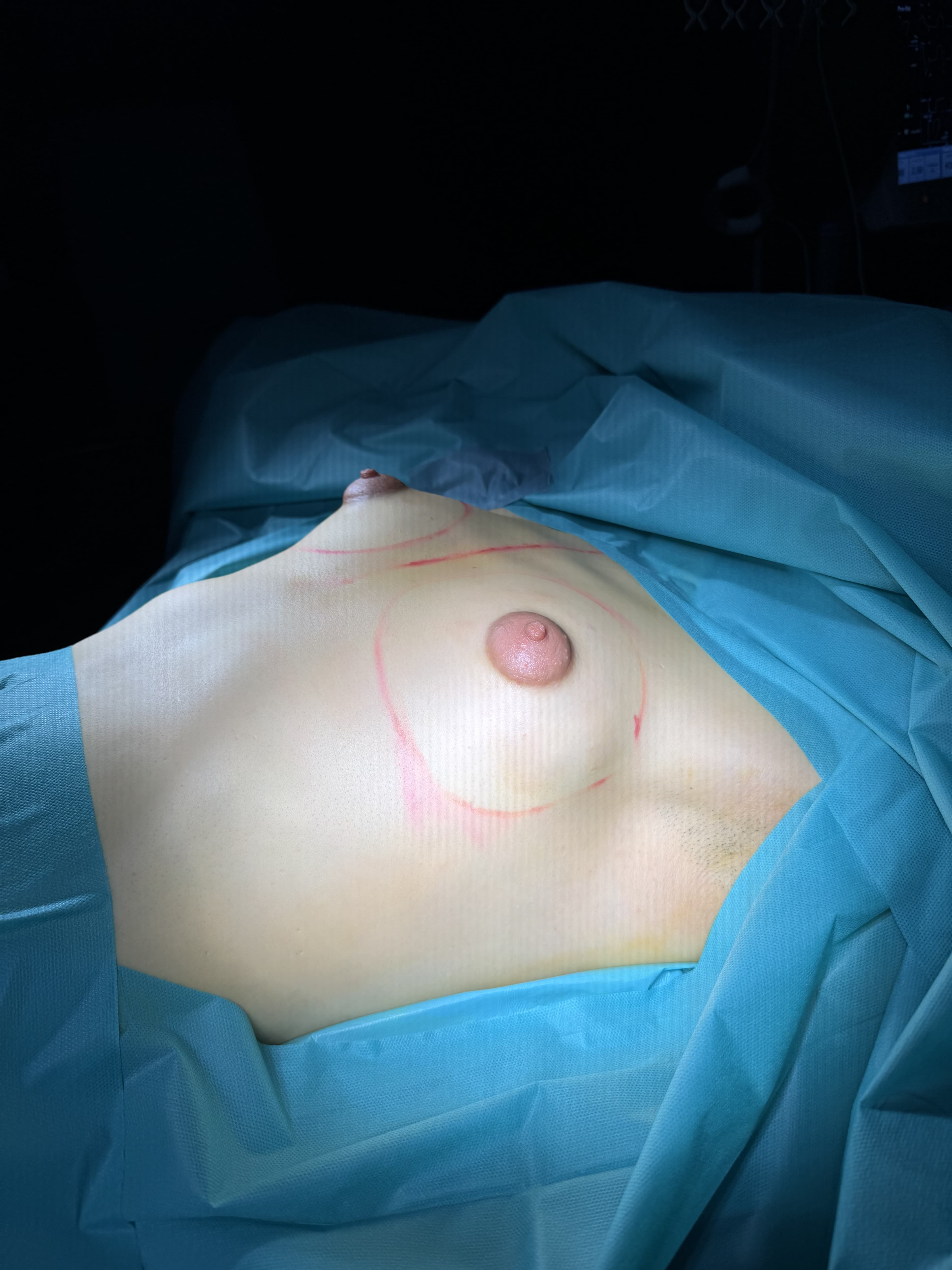 Top surgery: before