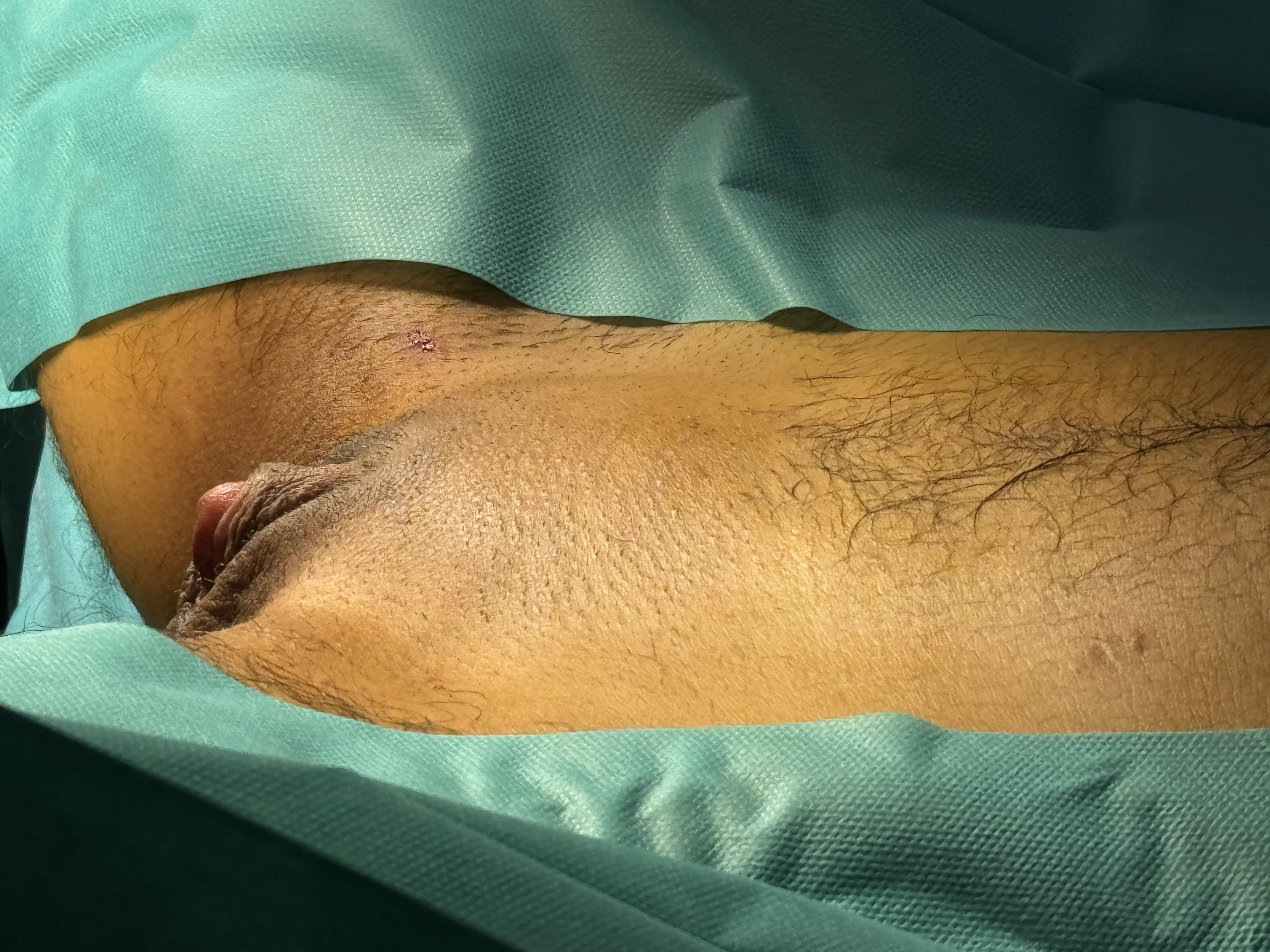 Metoidioplastia: después