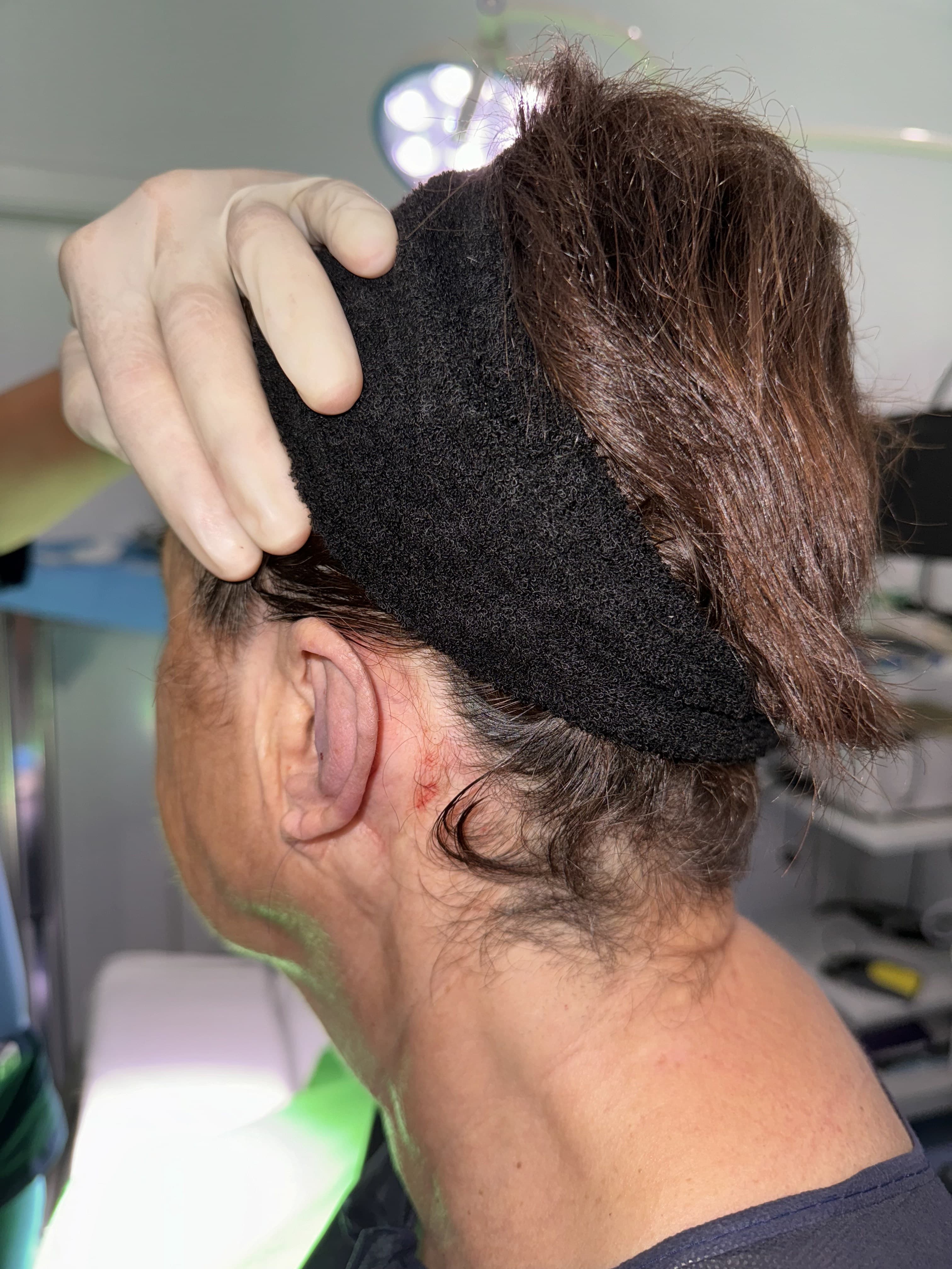 Otoplastia: después