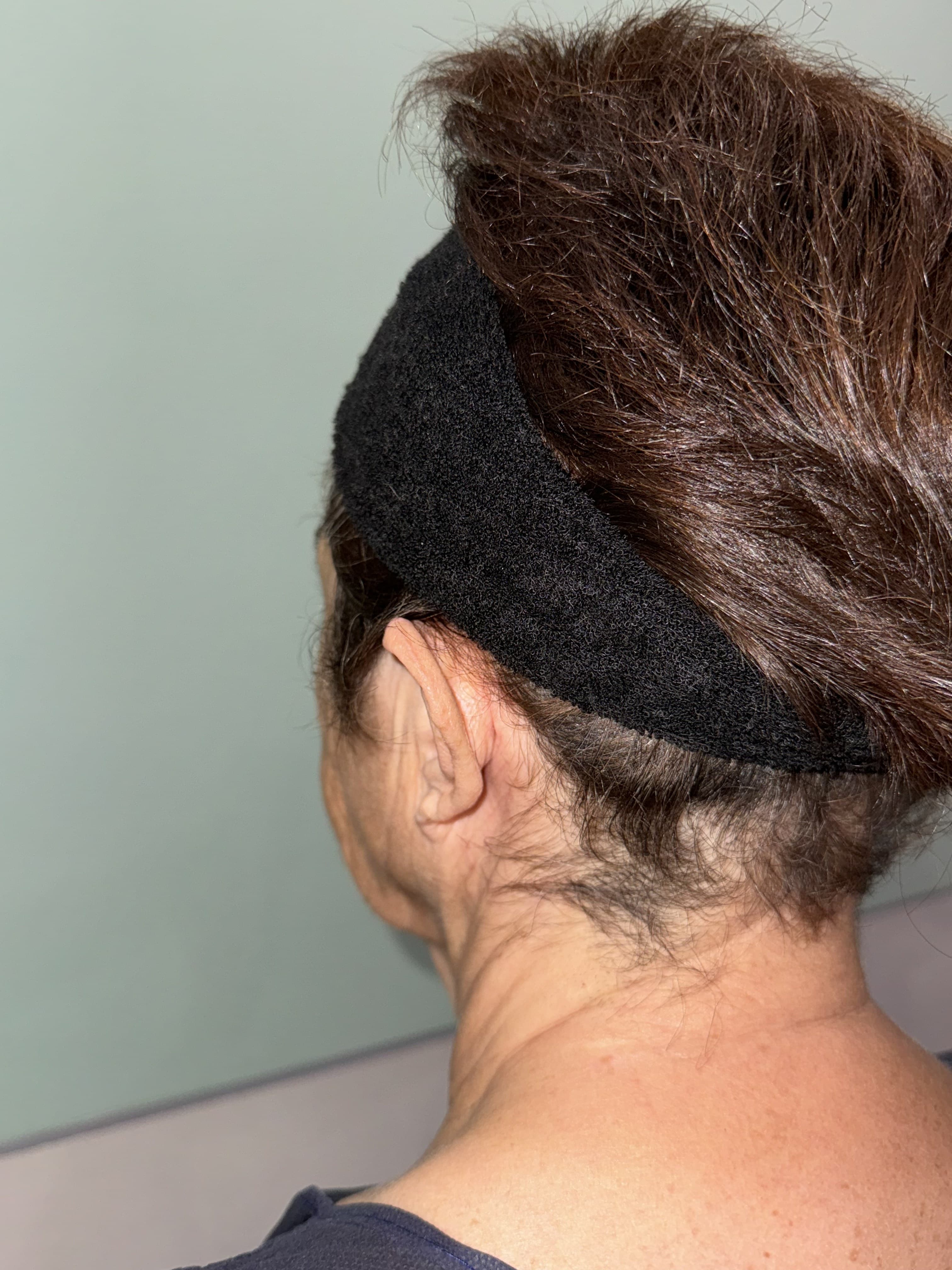 Otoplastia: antes