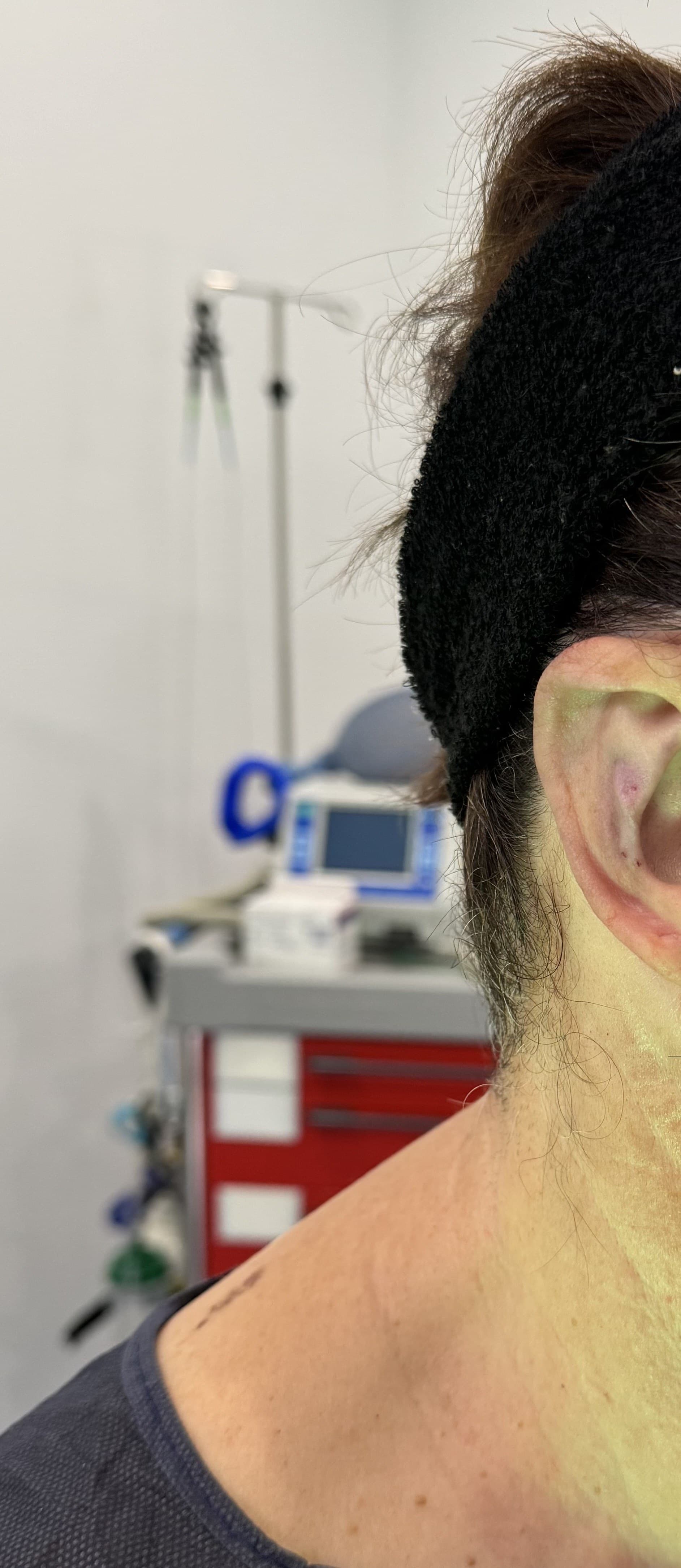 Otoplastia: después