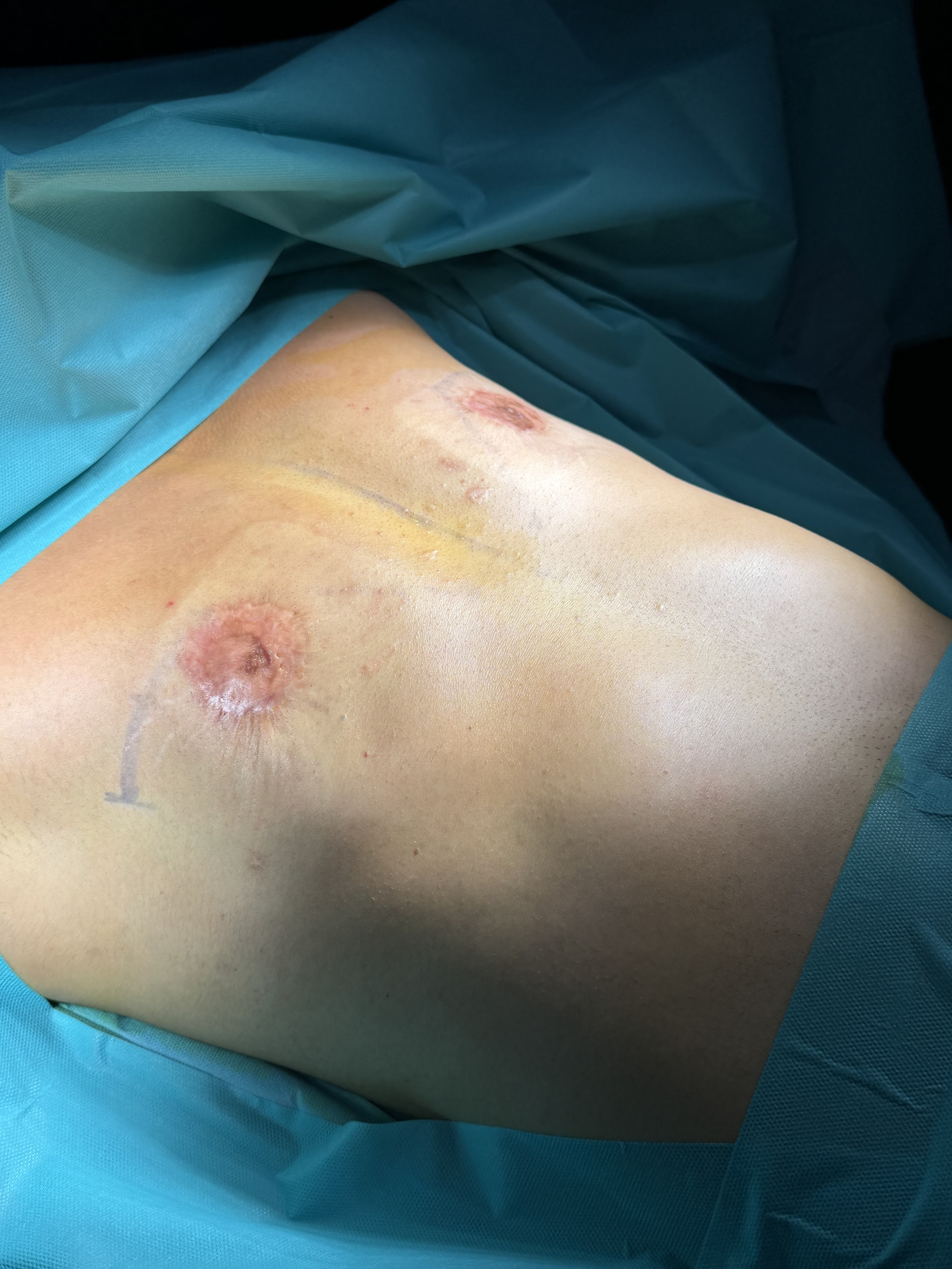 Reprise de mastectomie : photo avant l'intervention, cas 1