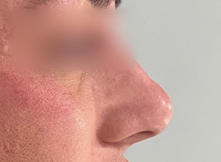 Rhinomodelation : après