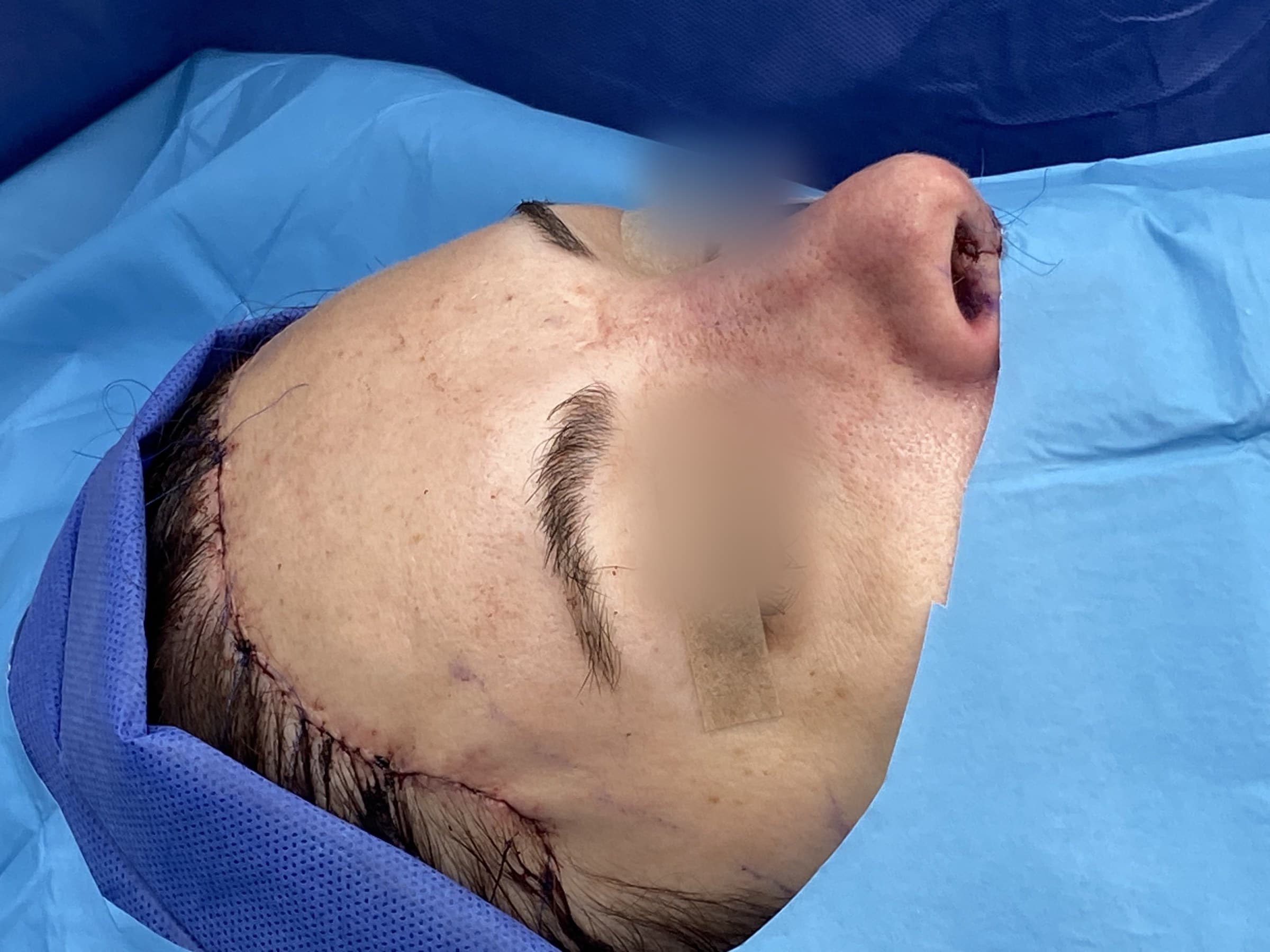 Rinoplastia de feminización: después