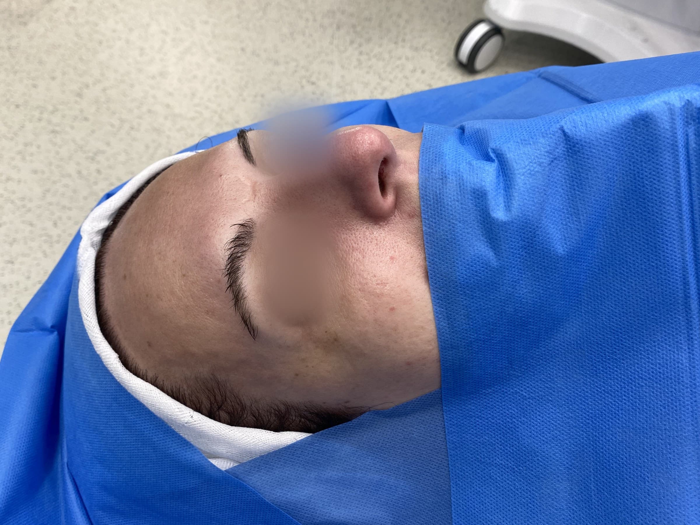 Rinoplastia de feminización: antes