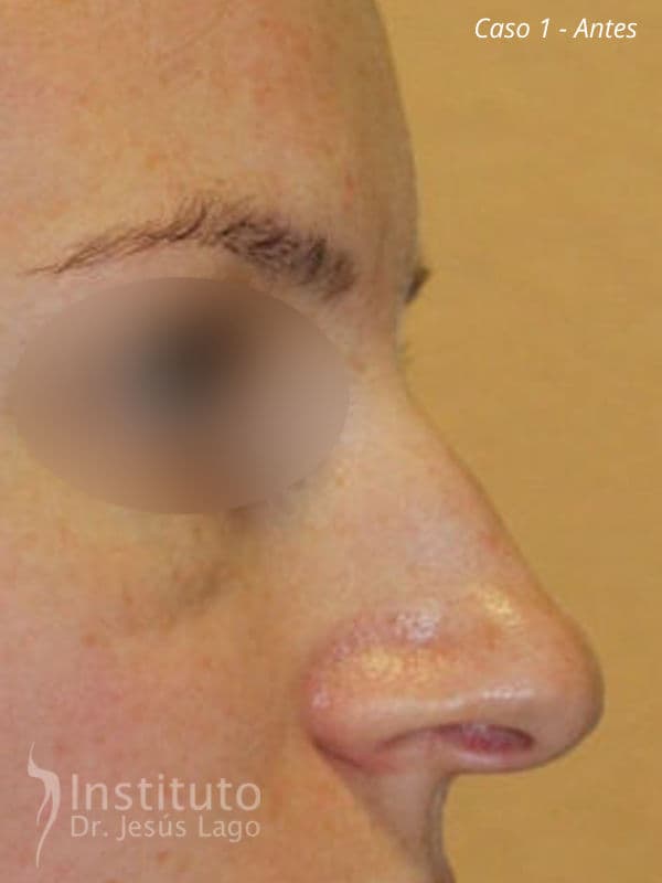 Rinoplastia: antes de la operación