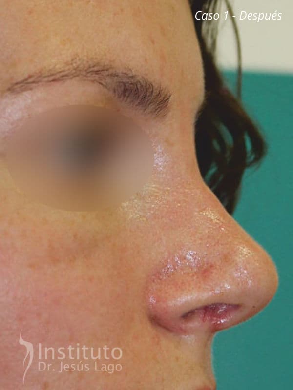 Rinoplastia: después de la operación