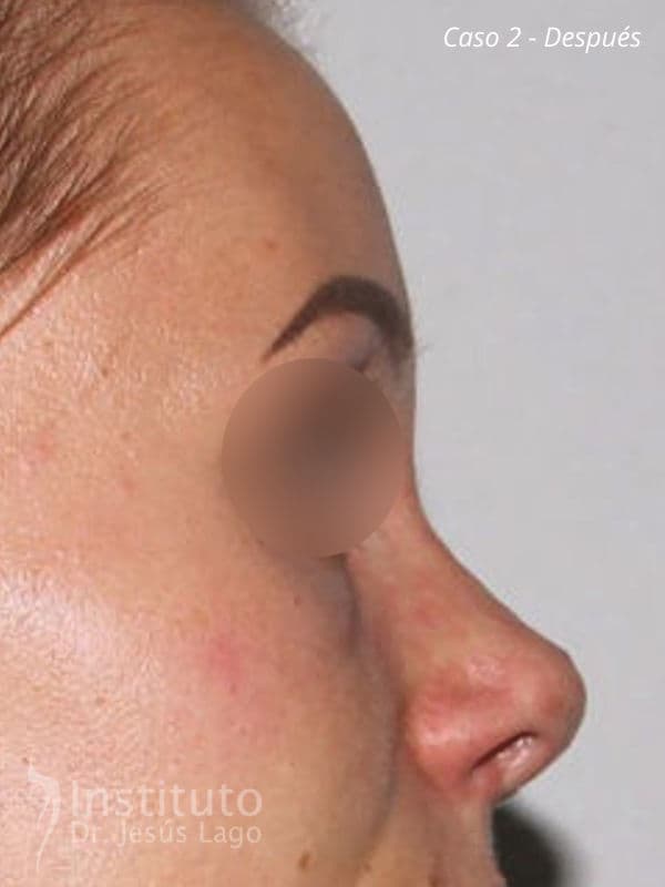 Rinoplastia: después de la operación