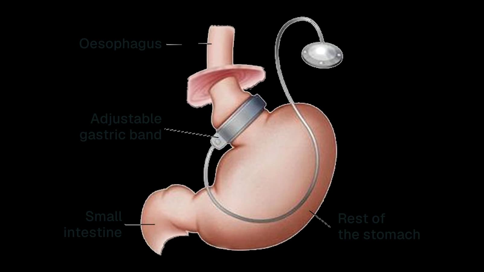 Diagram of the adjustable gastric band: the band sits around the top of the stomach, connected by a tube to a port under the skin