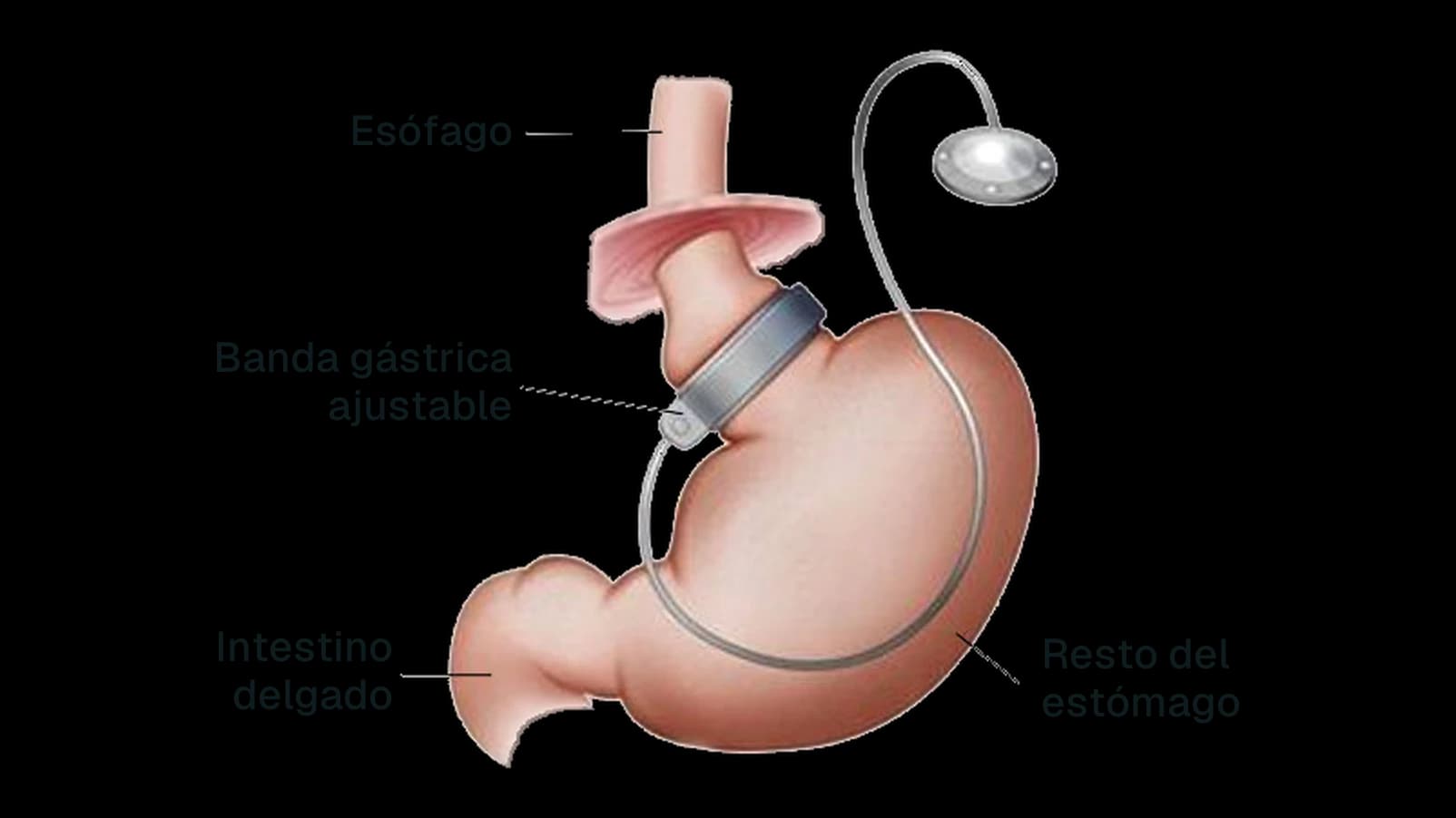Esquema de la banda gástrica ajustable: la banda rodea la parte alta del estómago y un tubo la conecta a un reservorio bajo la piel