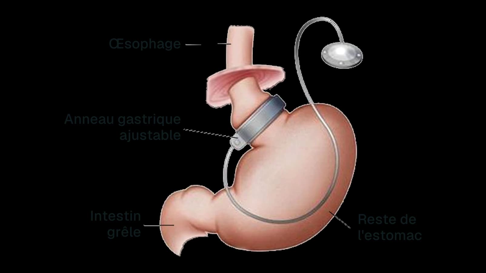 Schéma de l'anneau gastrique ajustable : anneau posé autour du haut de l'estomac, relié par un tube à un boîtier sous la peau