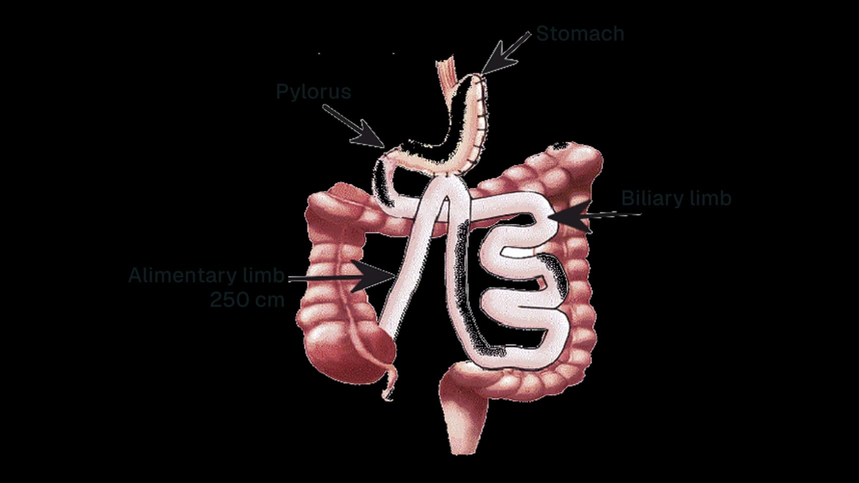 Diagram of BAGUA: stomach connected to the intestine by a single connection, with a 250 cm food limb and a biliary limb