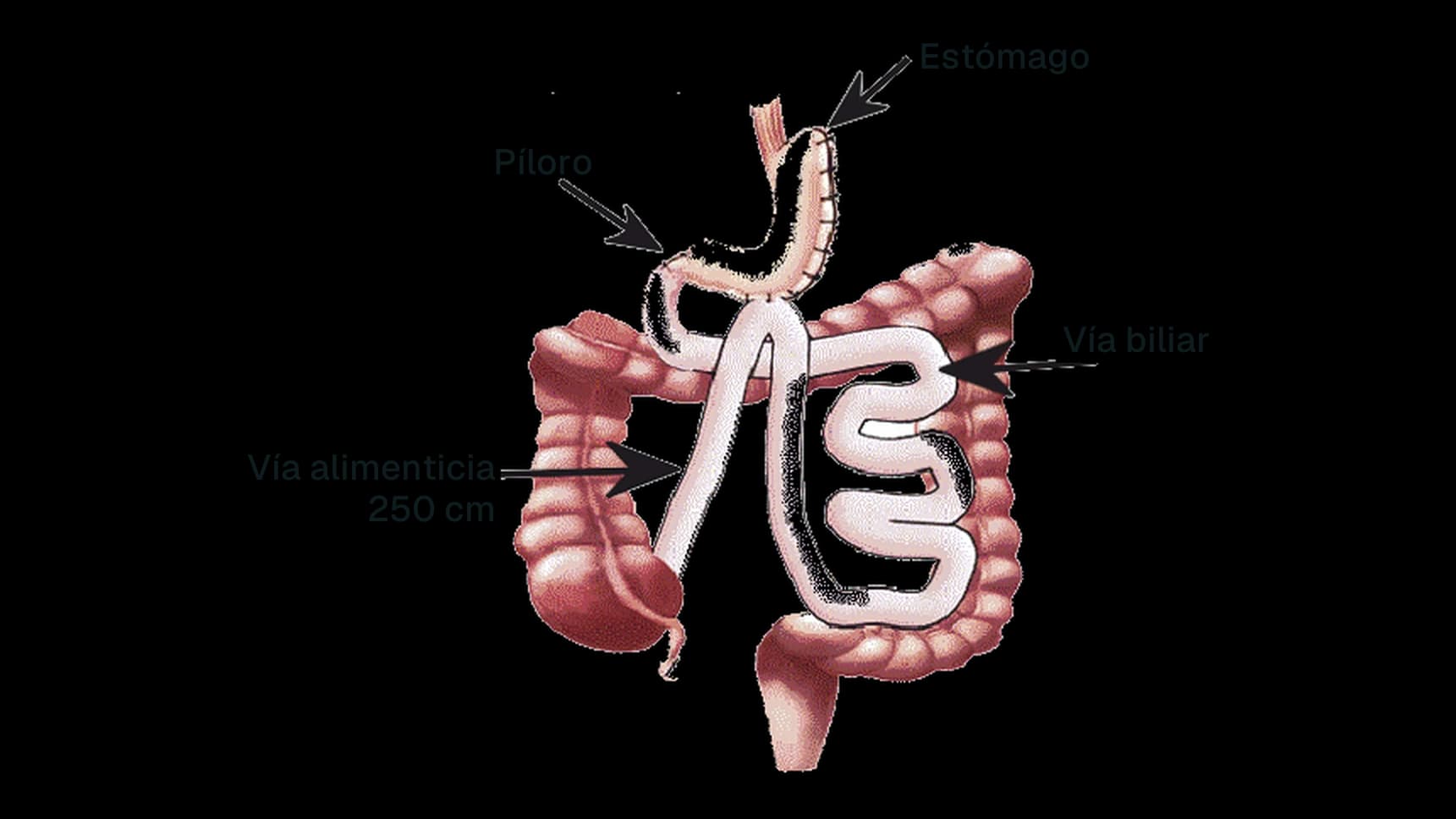 Esquema del BAGUA: estómago conectado al intestino con una sola unión, asa alimentaria de 250 cm y asa biliar