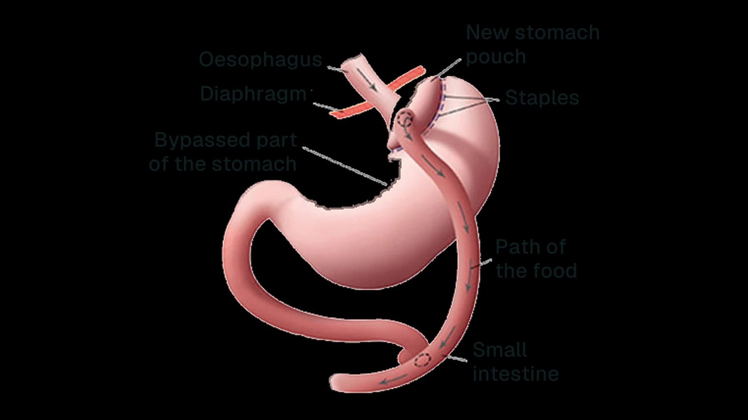 Diagram of the Roux-en-Y gastric bypass: new stapled stomach pouch connected to the small intestine, with part of the stomach bypassed