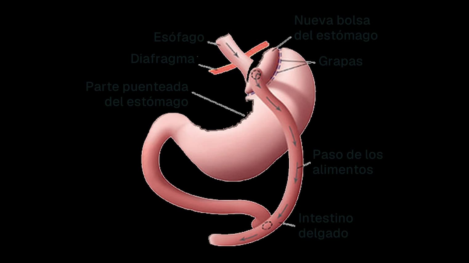 Esquema del bypass gástrico en Y de Roux: nueva bolsa gástrica grapada y conectada al intestino delgado, con una parte del estómago excluida