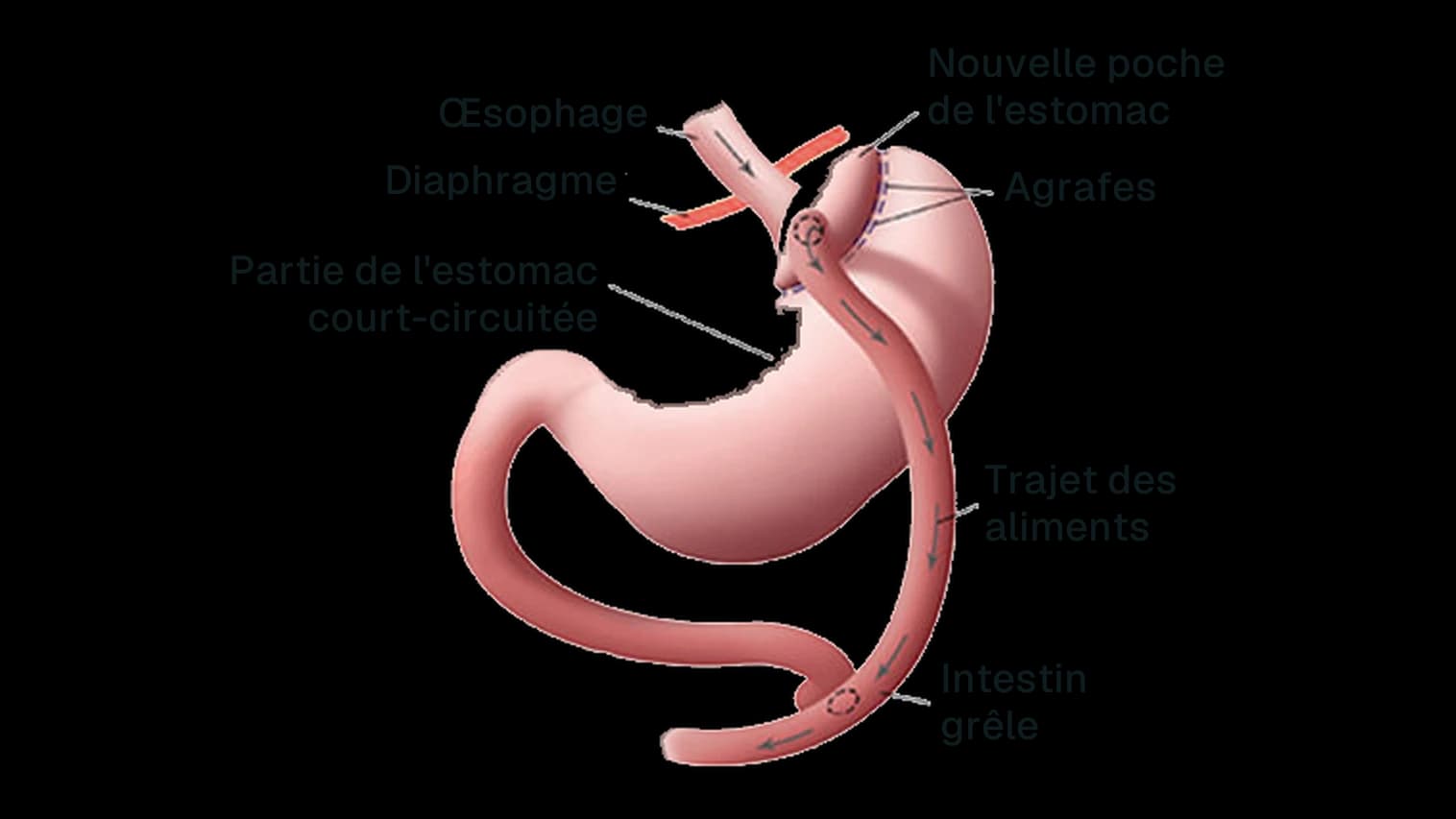 Schéma du bypass gastrique en Y-de-Roux : nouvelle poche d'estomac agrafée, raccordée à l'intestin grêle, partie de l'estomac court-circuitée