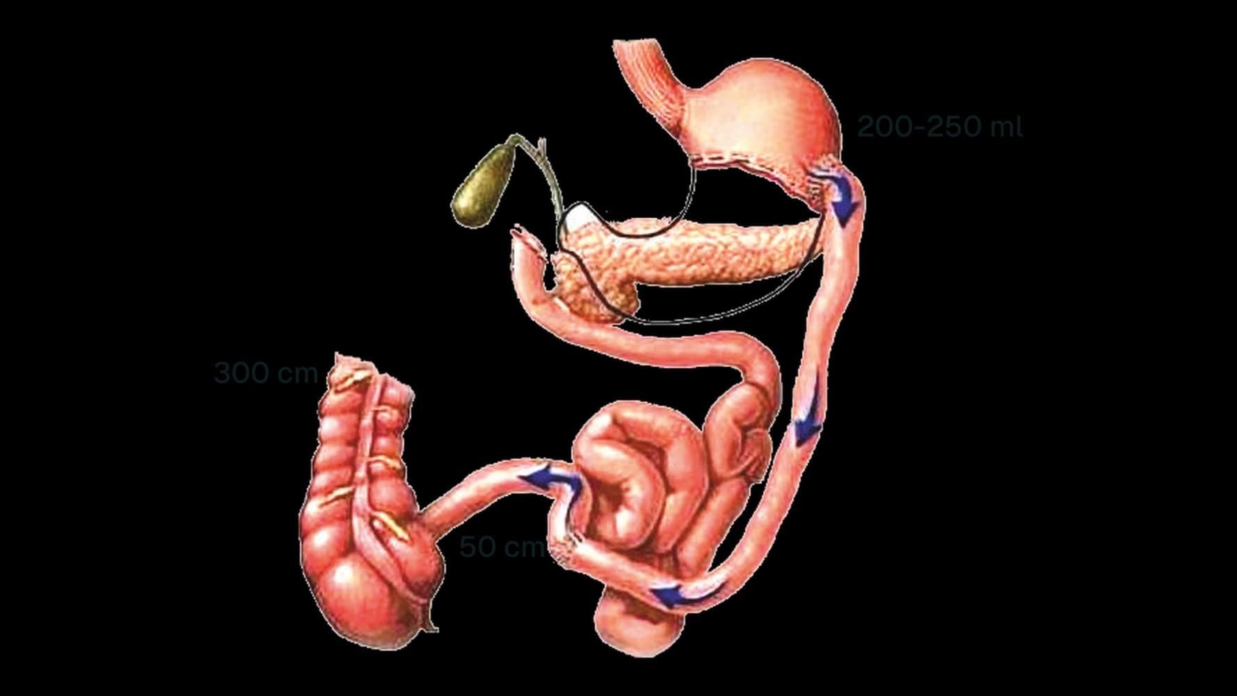Esquema del bypass biliopancreático: estómago de 200 a 250 ml, intestino unido en dos asas, con las longitudes de intestino en centímetros