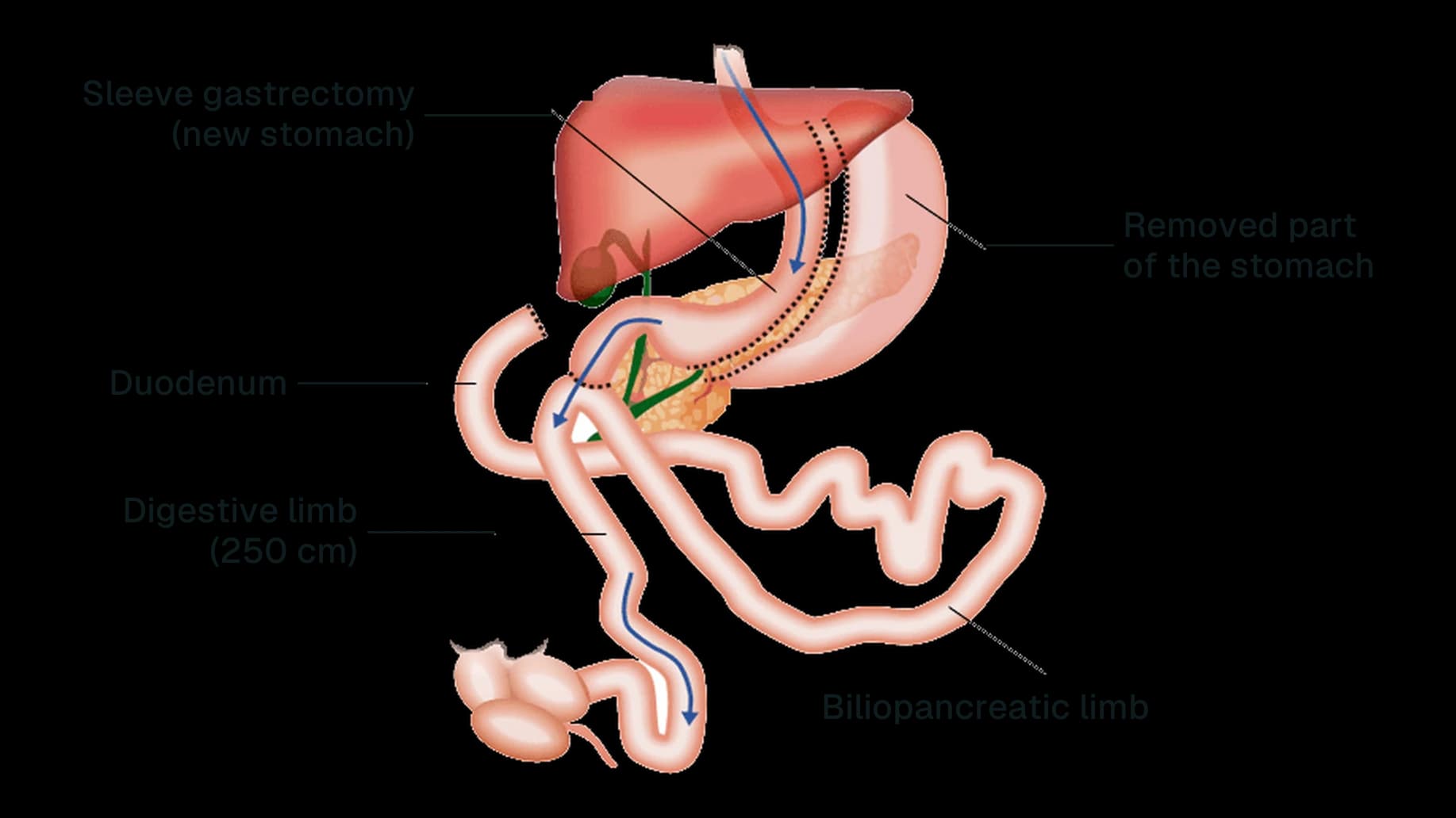 Diagram of SADI-S: tube-shaped stomach, duodenum connected to the intestine, 250 cm food limb and biliopancreatic limb