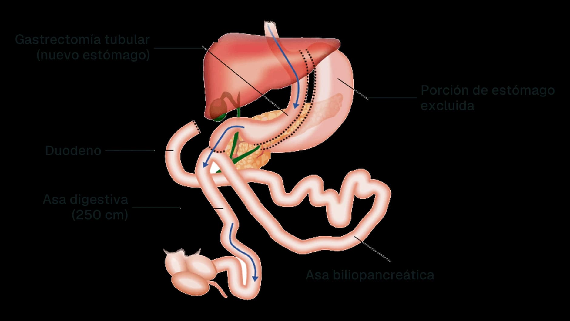 Esquema del SADI-S: estómago en forma de tubo, duodeno conectado al intestino, asa alimentaria de 250 cm y asa biliopancreática