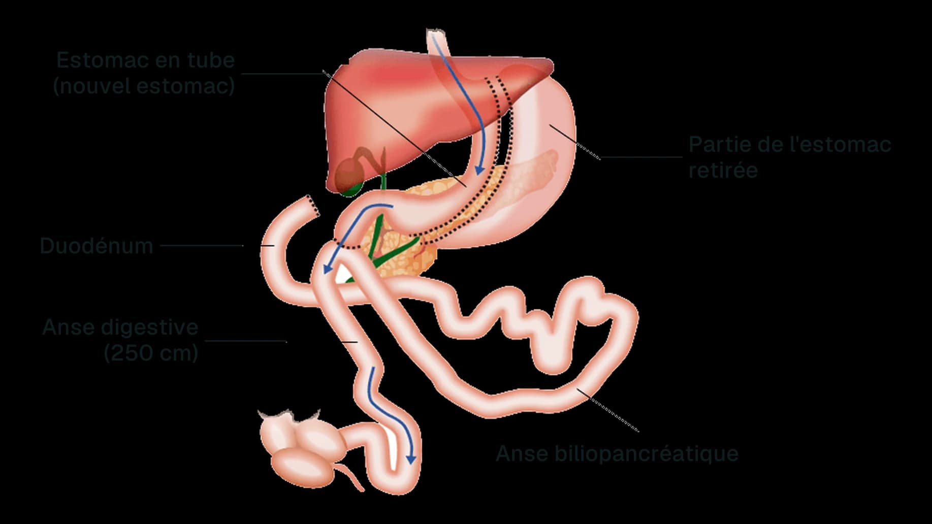 Schéma du SADI-S : estomac en tube, duodénum raccordé à l'intestin, anse digestive de 250 cm et anse biliopancréatique