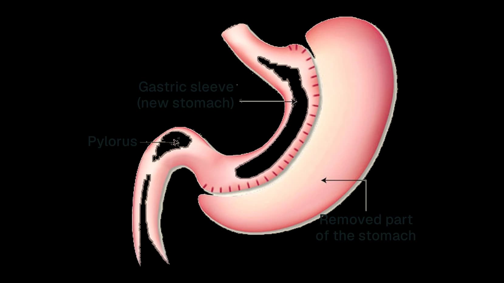 Diagram of the gastric sleeve: stomach reduced to a tube, part of the stomach removed, pylorus preserved